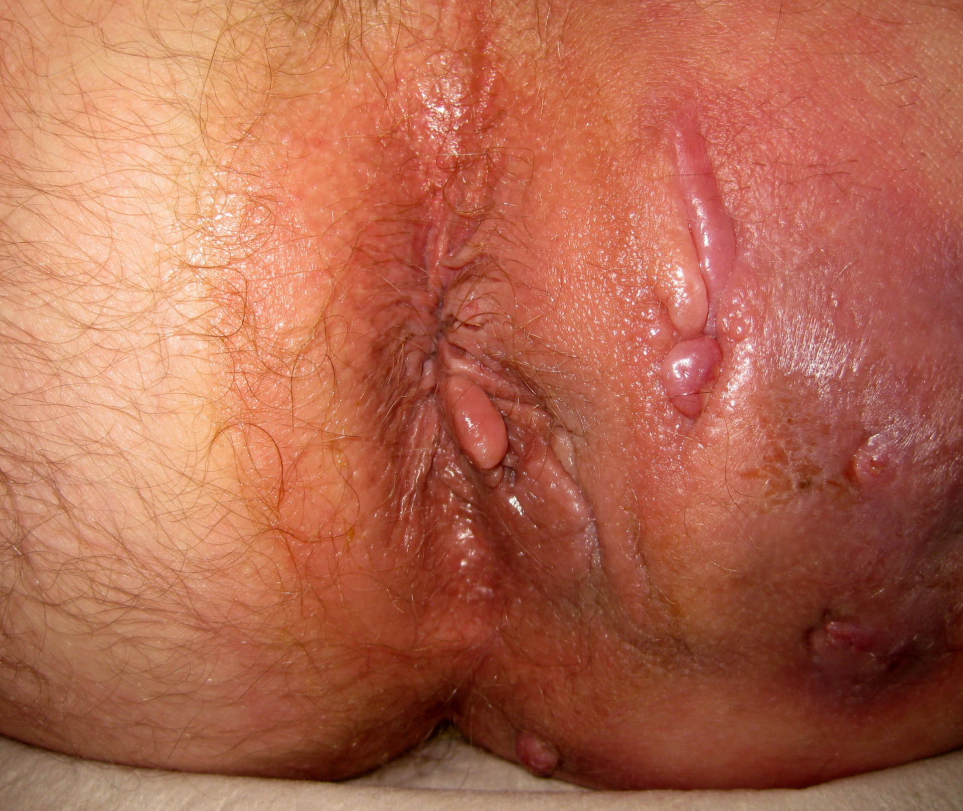 Permanent Cure Of Anal Fistula.