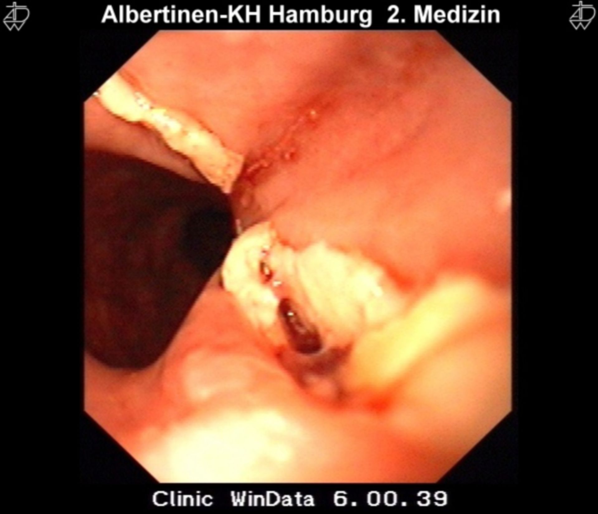 Pill embolus perforation