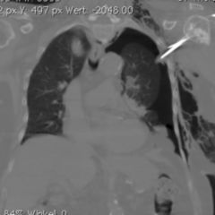 Hautemphysem DocCheck Flexikon