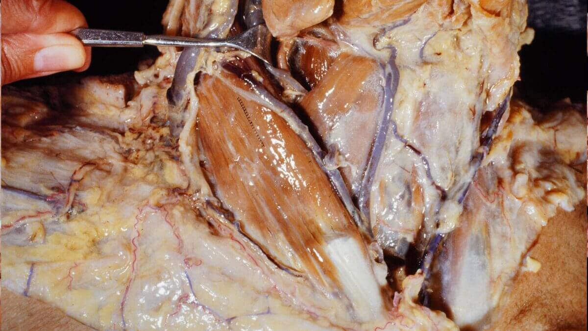 Musculus sternocleidomastoideus