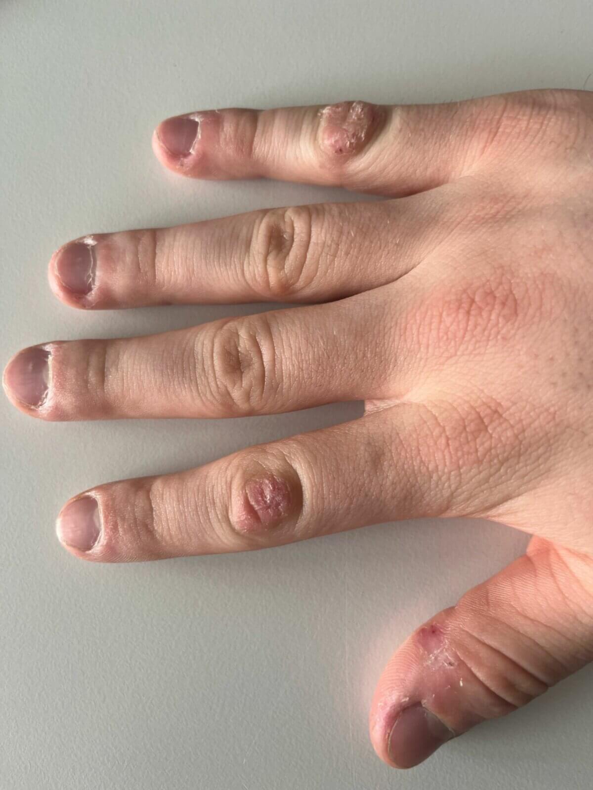 Dermatophagie