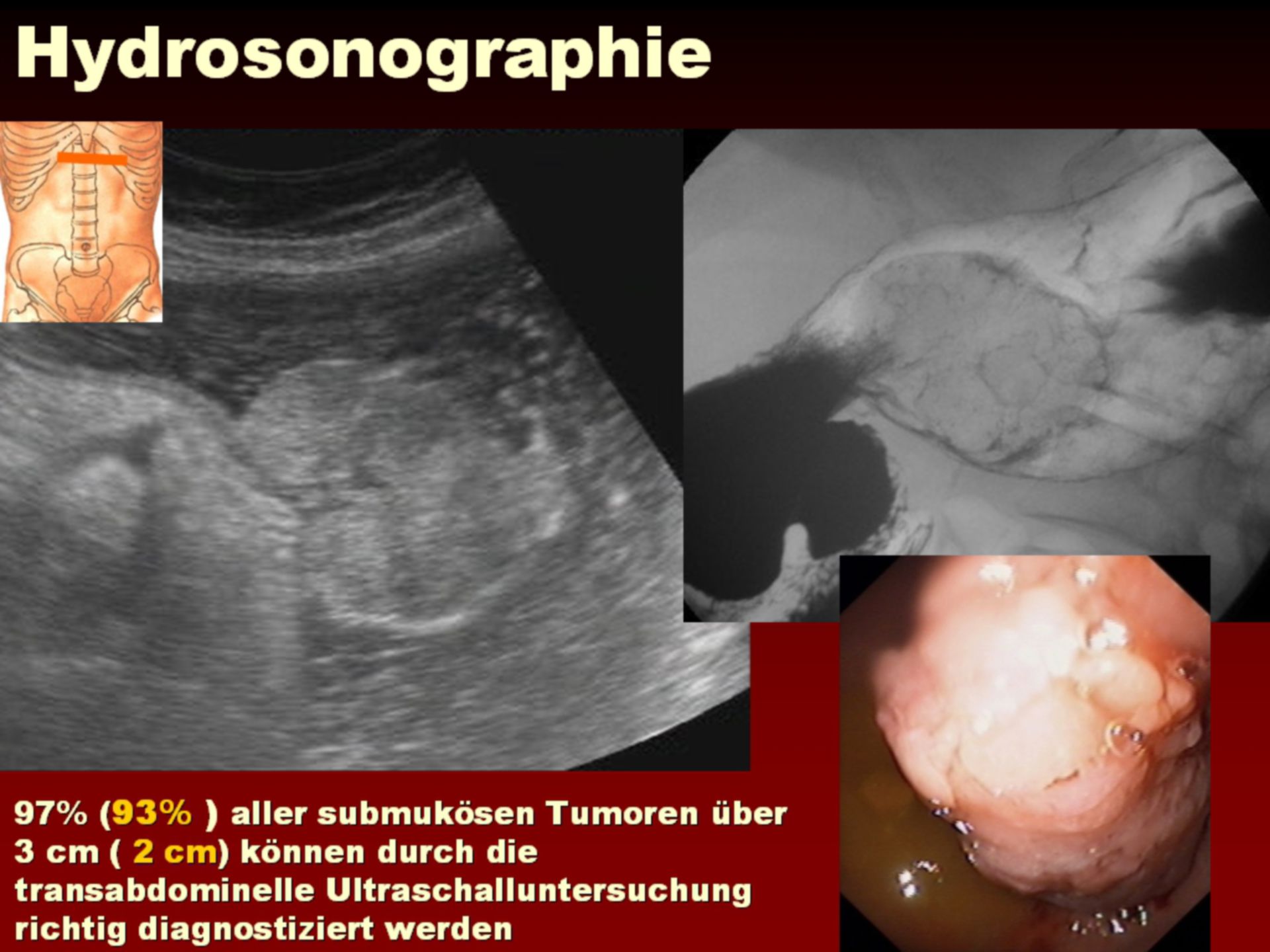 Hydrosonography