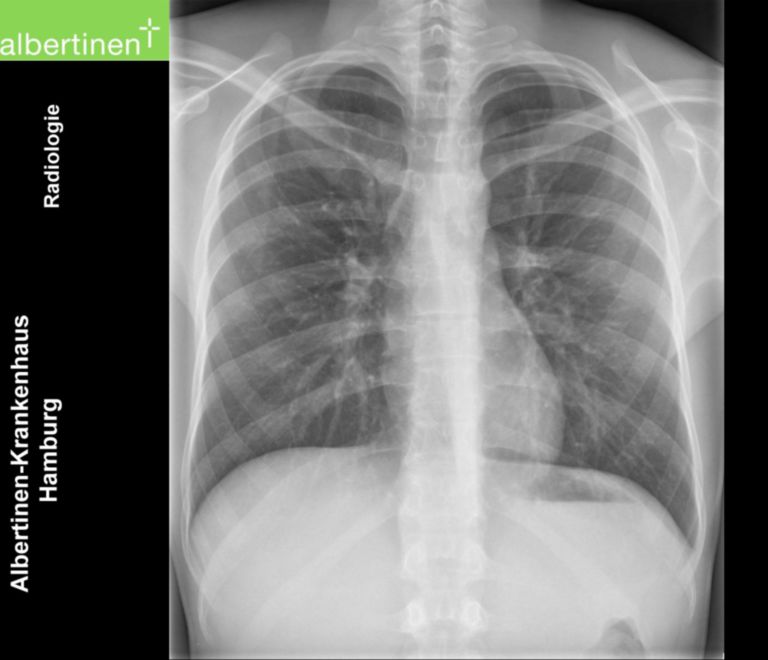 X-ray of the thorax, p.a.: Normal finding - DocCheck