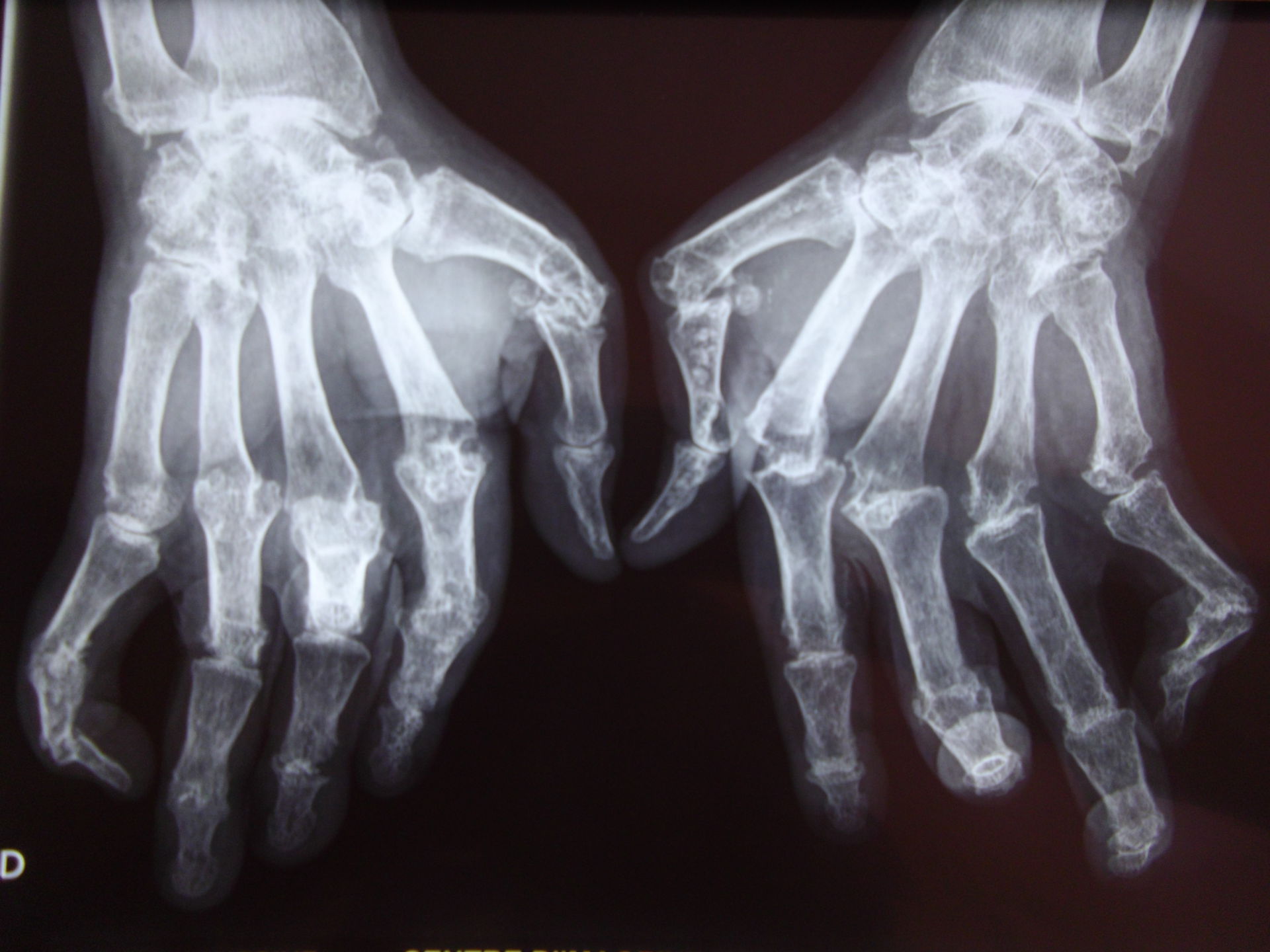 Hand bei rheumatoider Arthritis