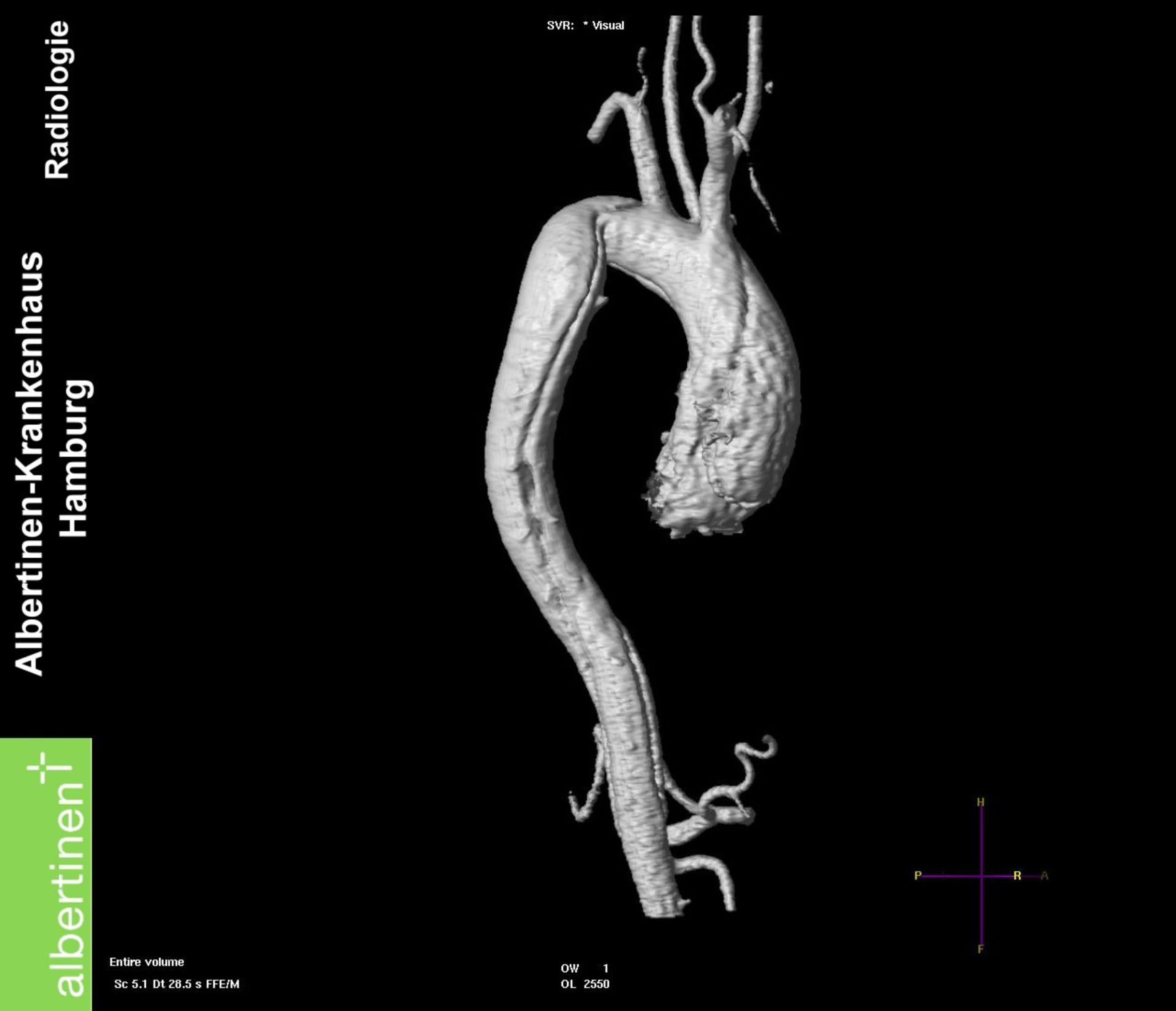 Tomografia a risonanza magnetica - dissecazione aortica