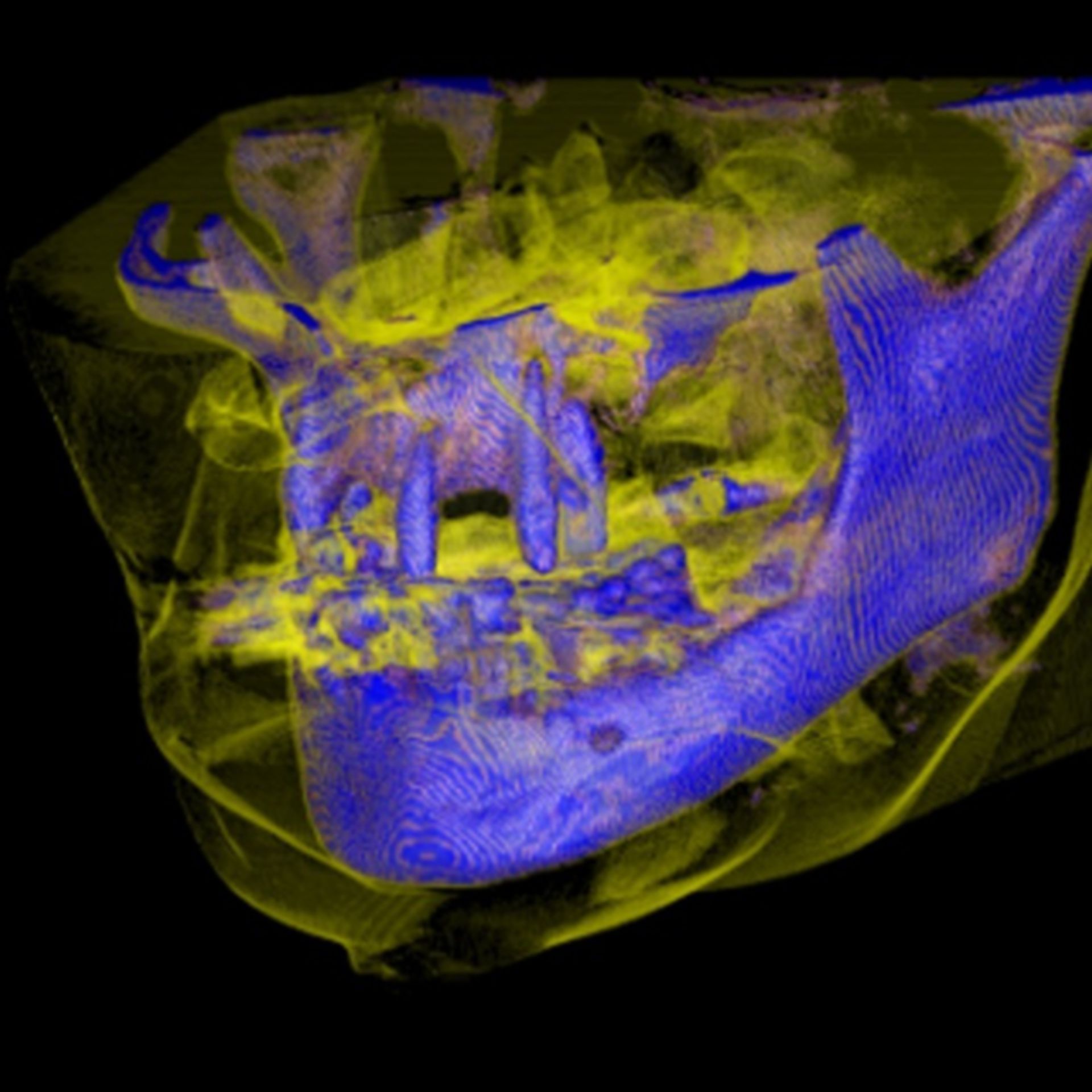 3D-Reconstruction of the maxilla and mandibula through CBCT