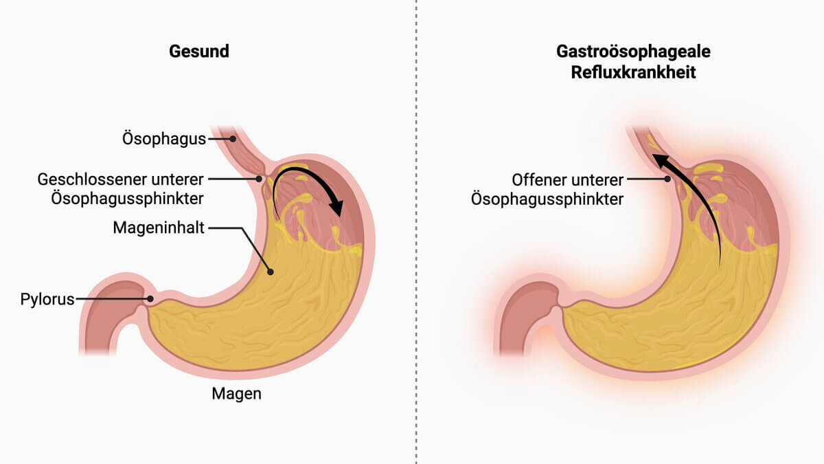 Gastroösophageale Refluxkrankheit