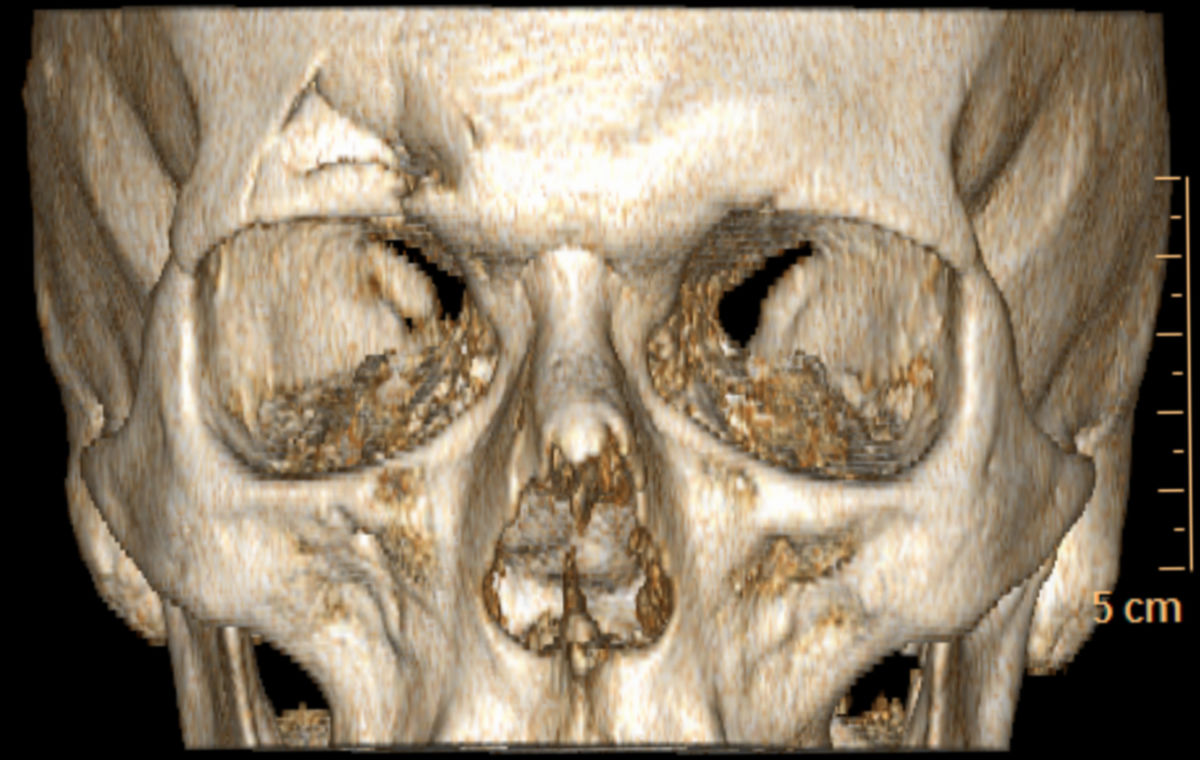 Fraktur der Stirnhöhle (CT-Rekonstruktion)