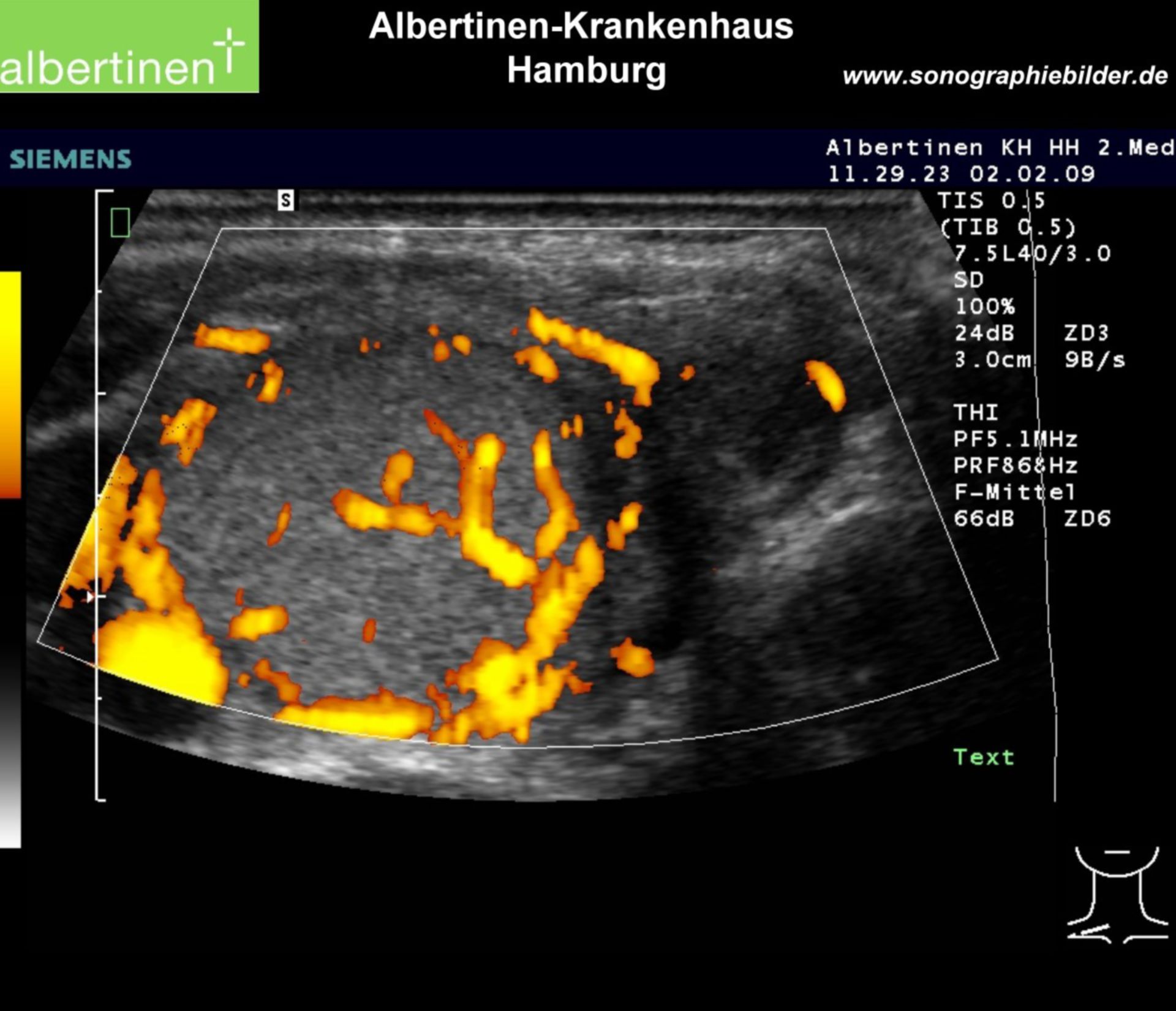Thyroid adenoma - doppler image