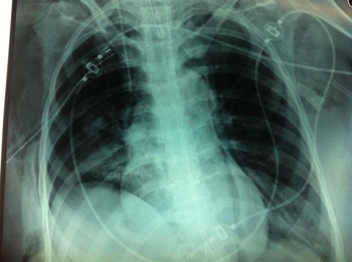 Spannungspneumothorax nach Entlastung