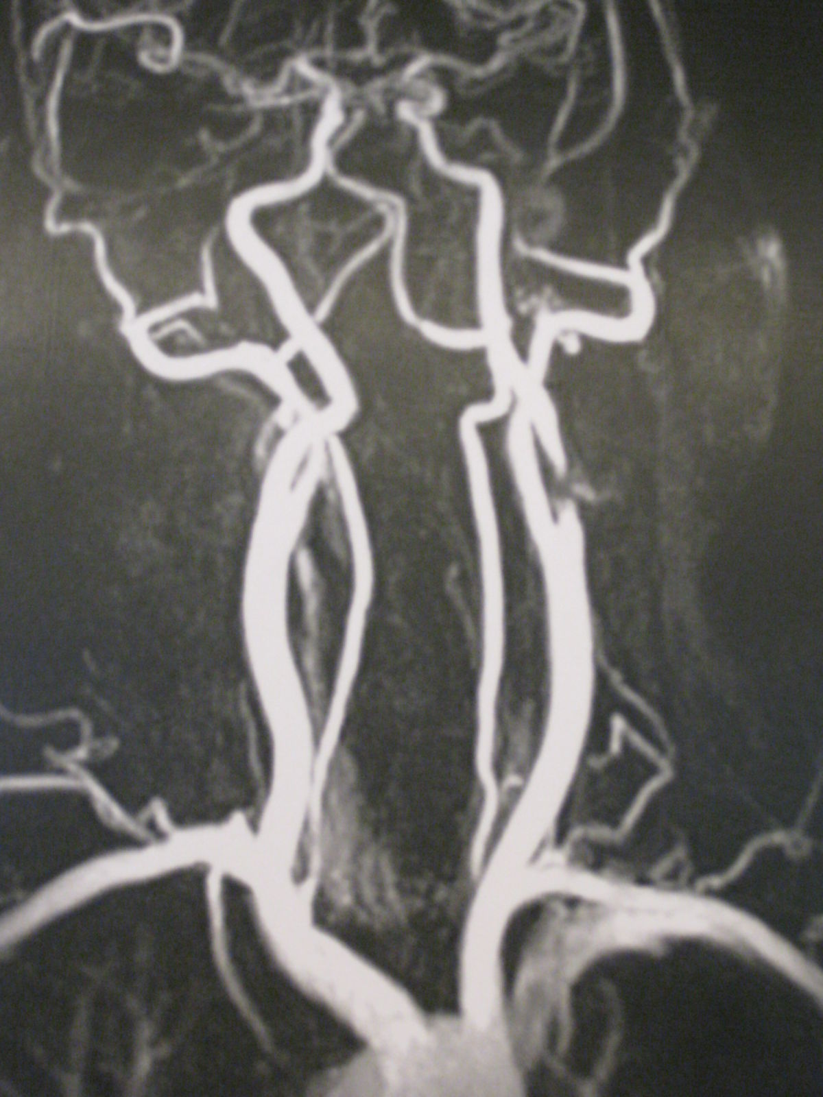 Carotisstenose links-MR Angiografie