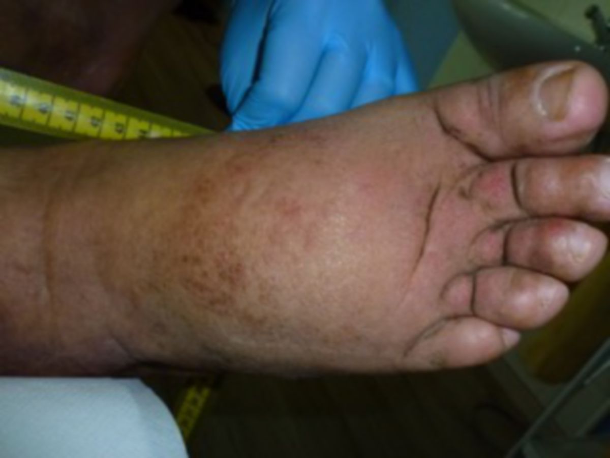 3sekundares-lymphodem-mit- 