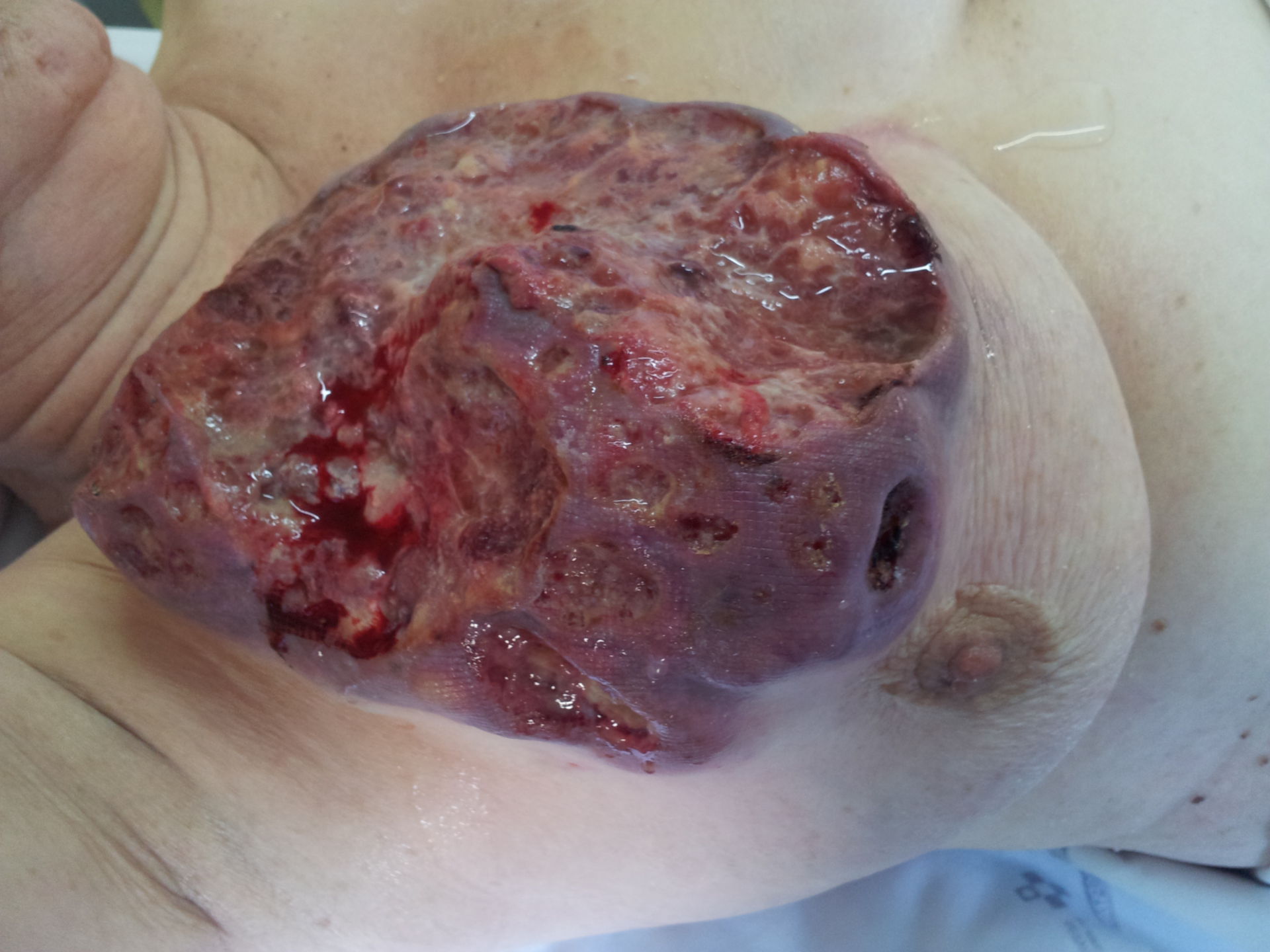 Carcinoma mammario (1)