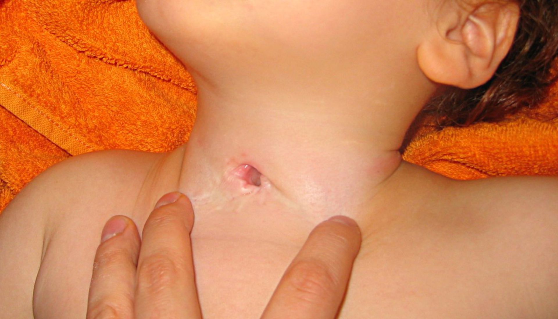 Tracheostoma bei einem Kleinkind