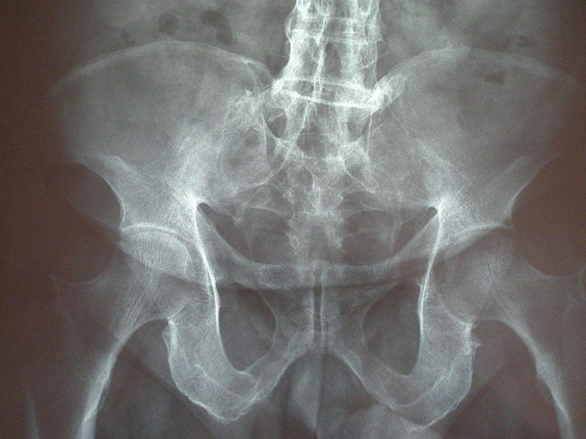 Spondylitis Ankylosans Doccheck