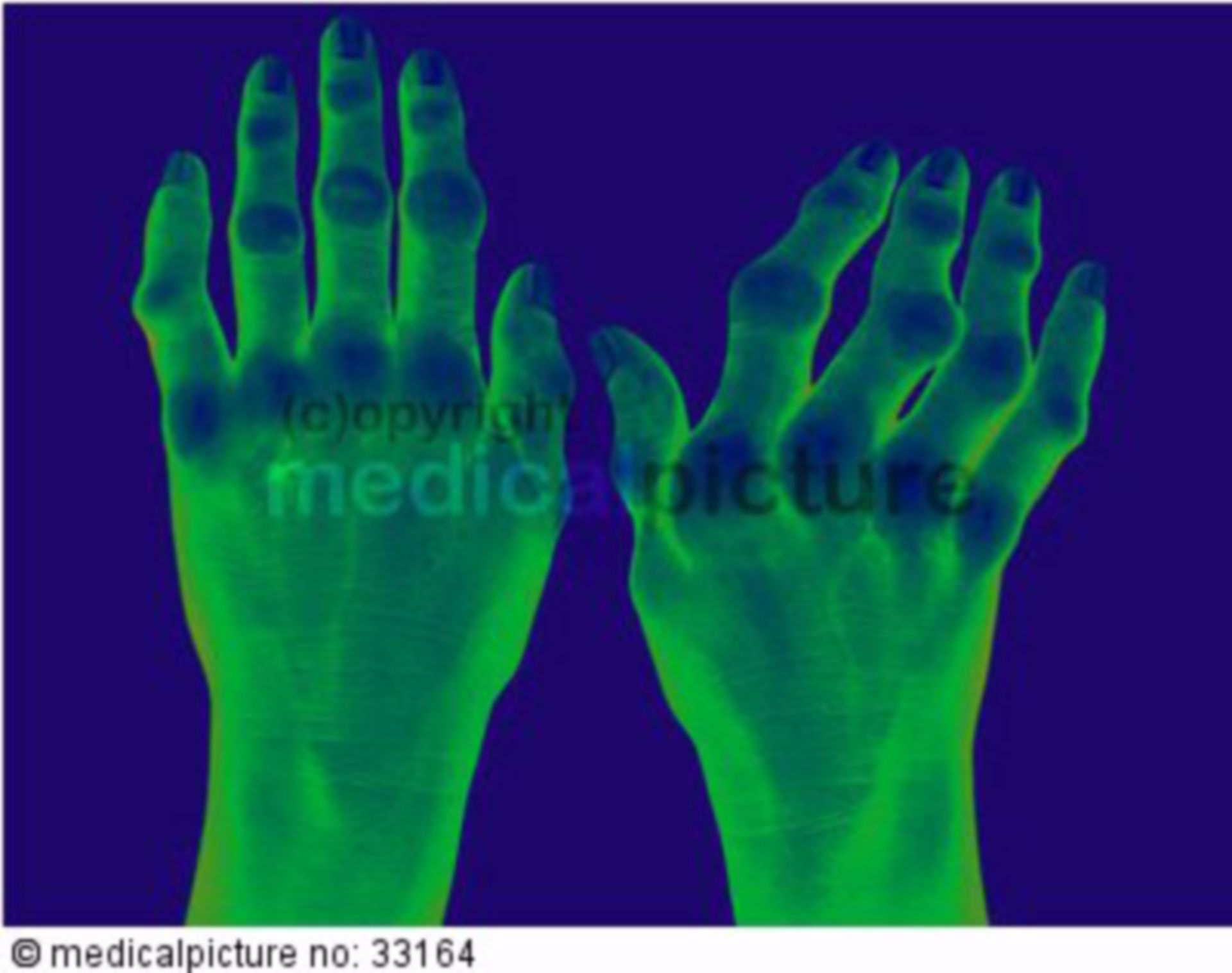  Deformierte Hände infolge rheumatoider Arthritis 
