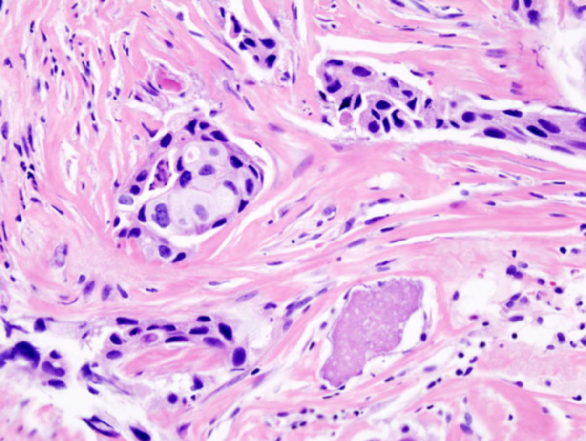 Brustkrebs (Histologie)