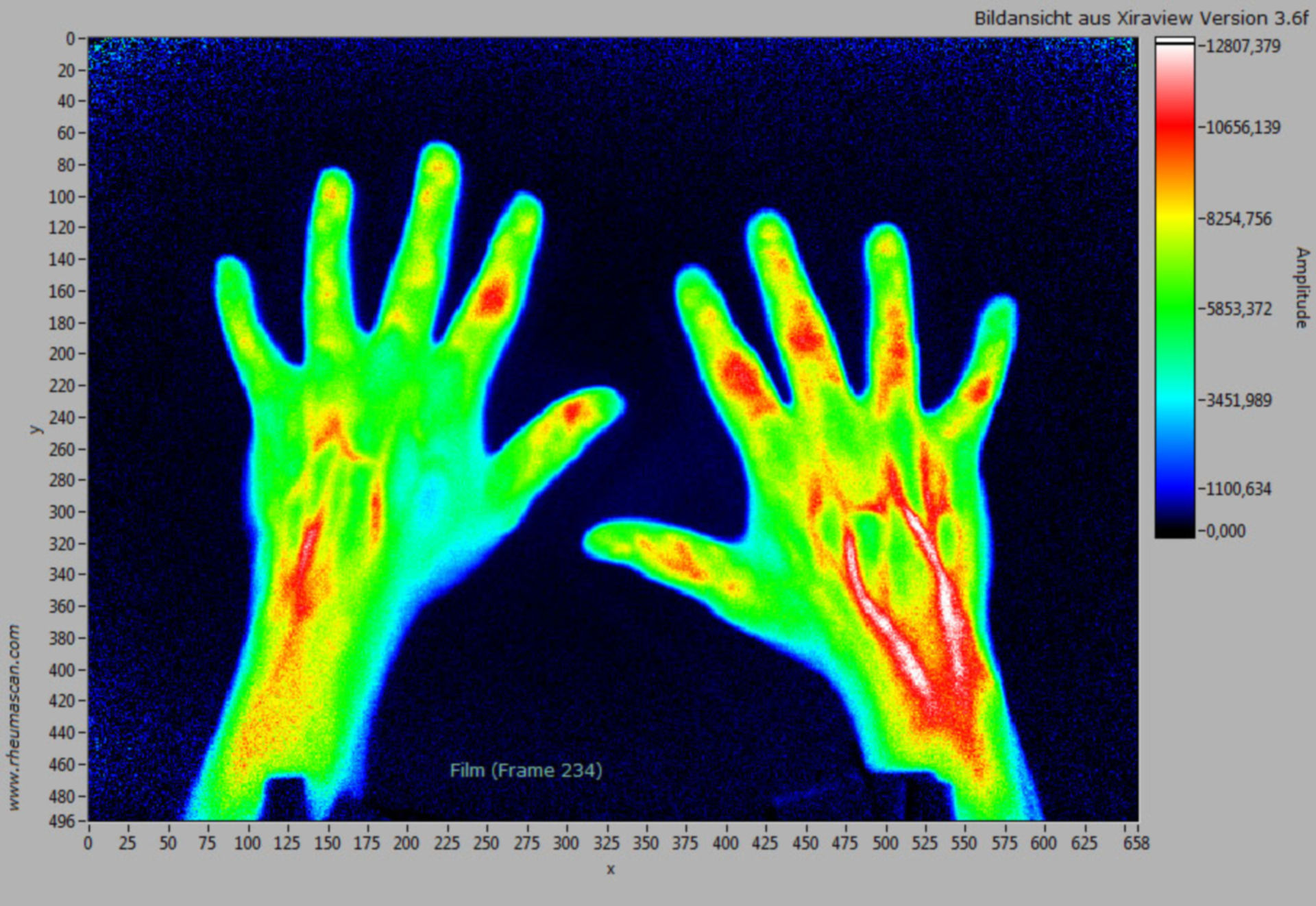 Rheumascan-Xiralite-Rheumatoide Arthritis