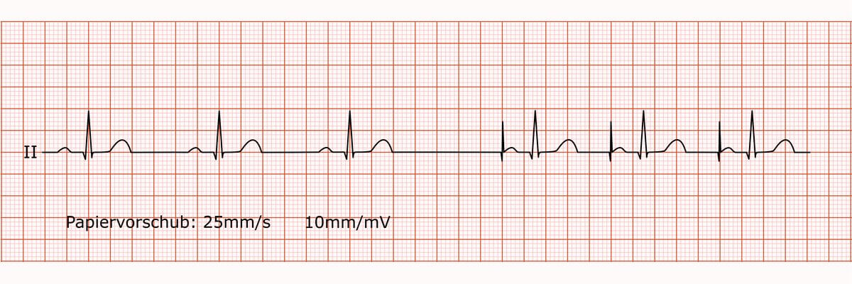 Rhythmusstreifen mit Sinusbradykardie,Triggerpause und konsekutivem AAI-Schrittmachereinsatz