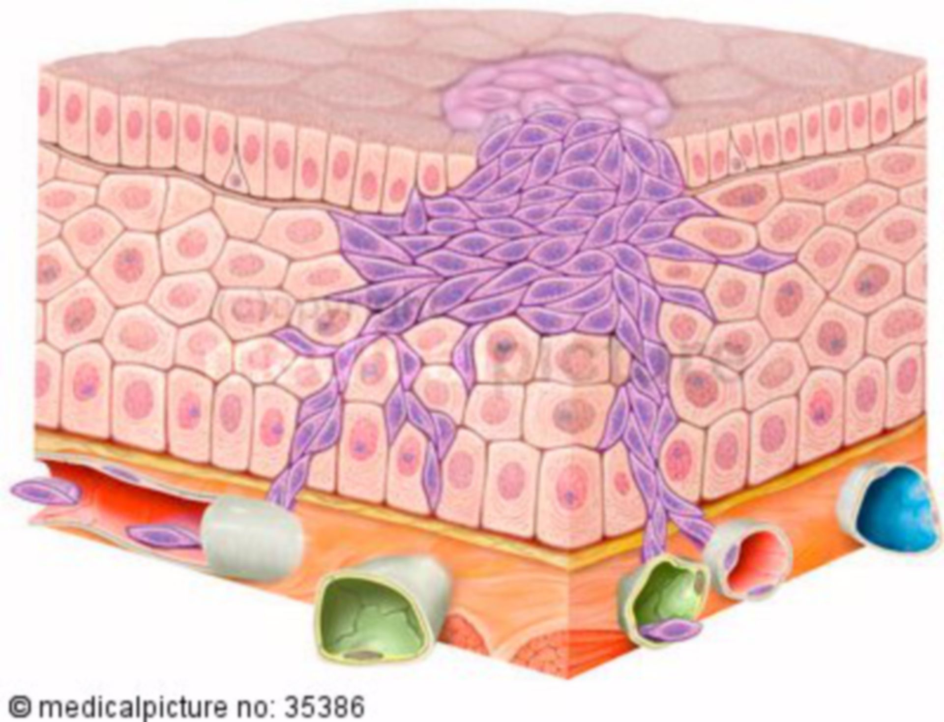 Tumor cells, genesis of a carcinoma