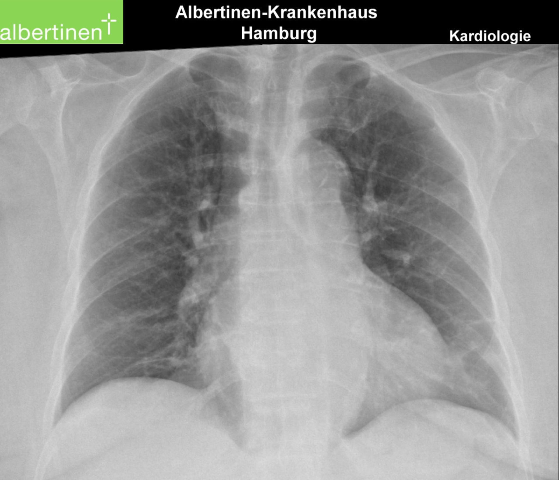 Rekompensierte Herzinsuffizienz (Röntgen-Thorax)