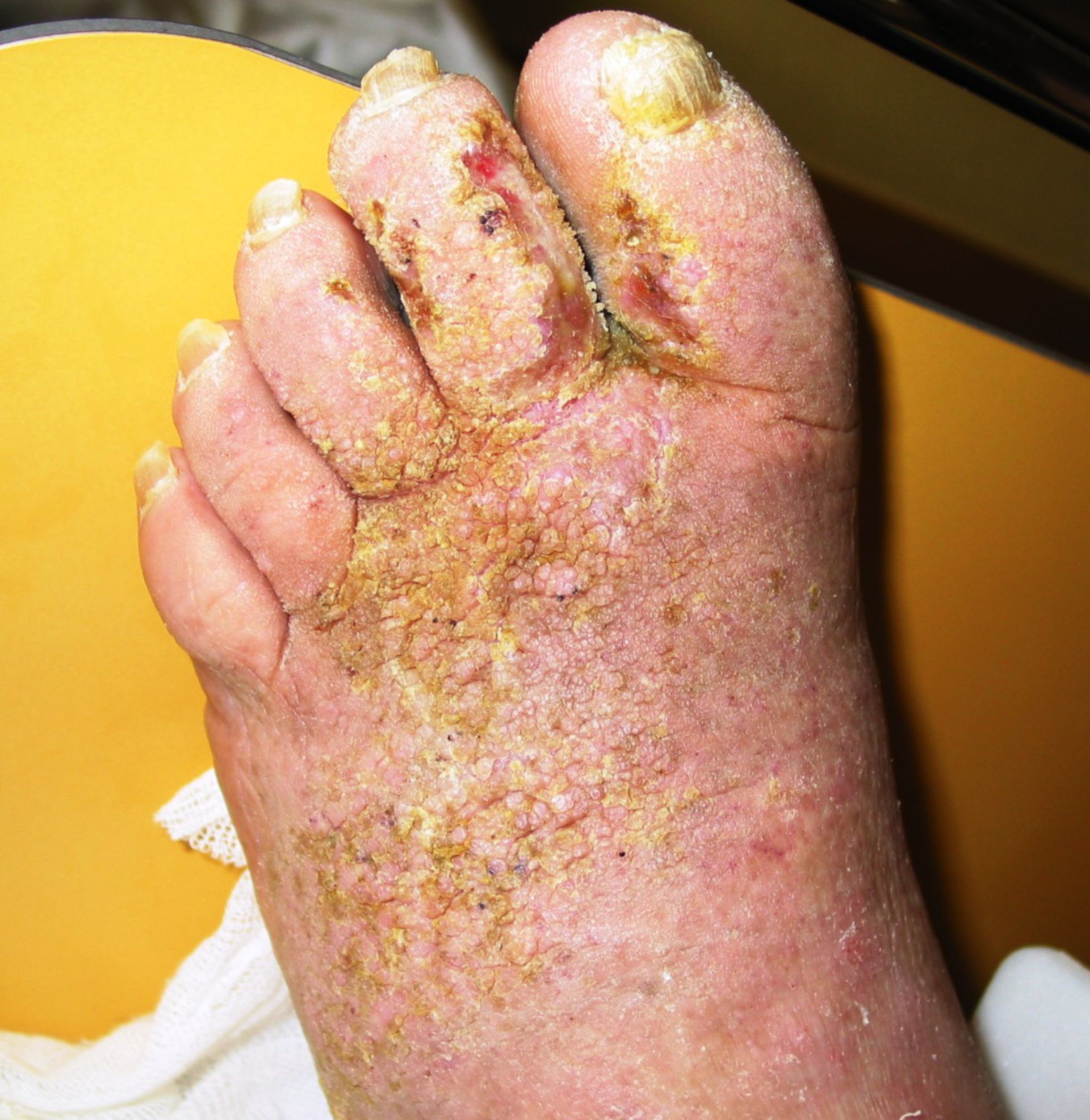 Hyperkeratosis with fungal superinfektion