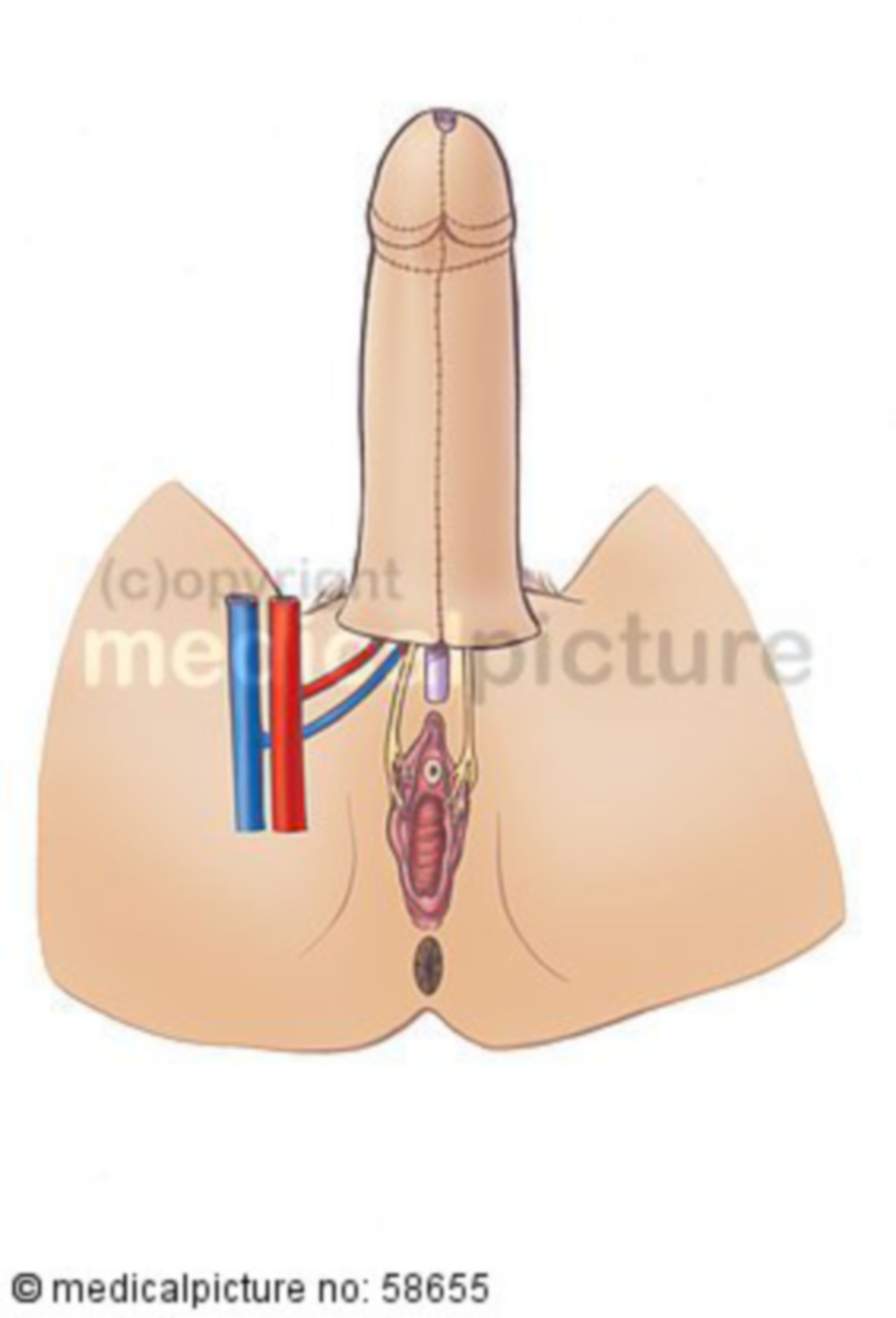 Penis-(re)construction (attachement to female anatomy)
