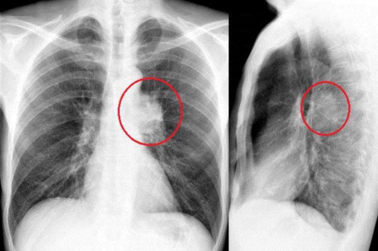 Hil Rf Röntgen Des Thorax In 2 Ebenen Doccheck