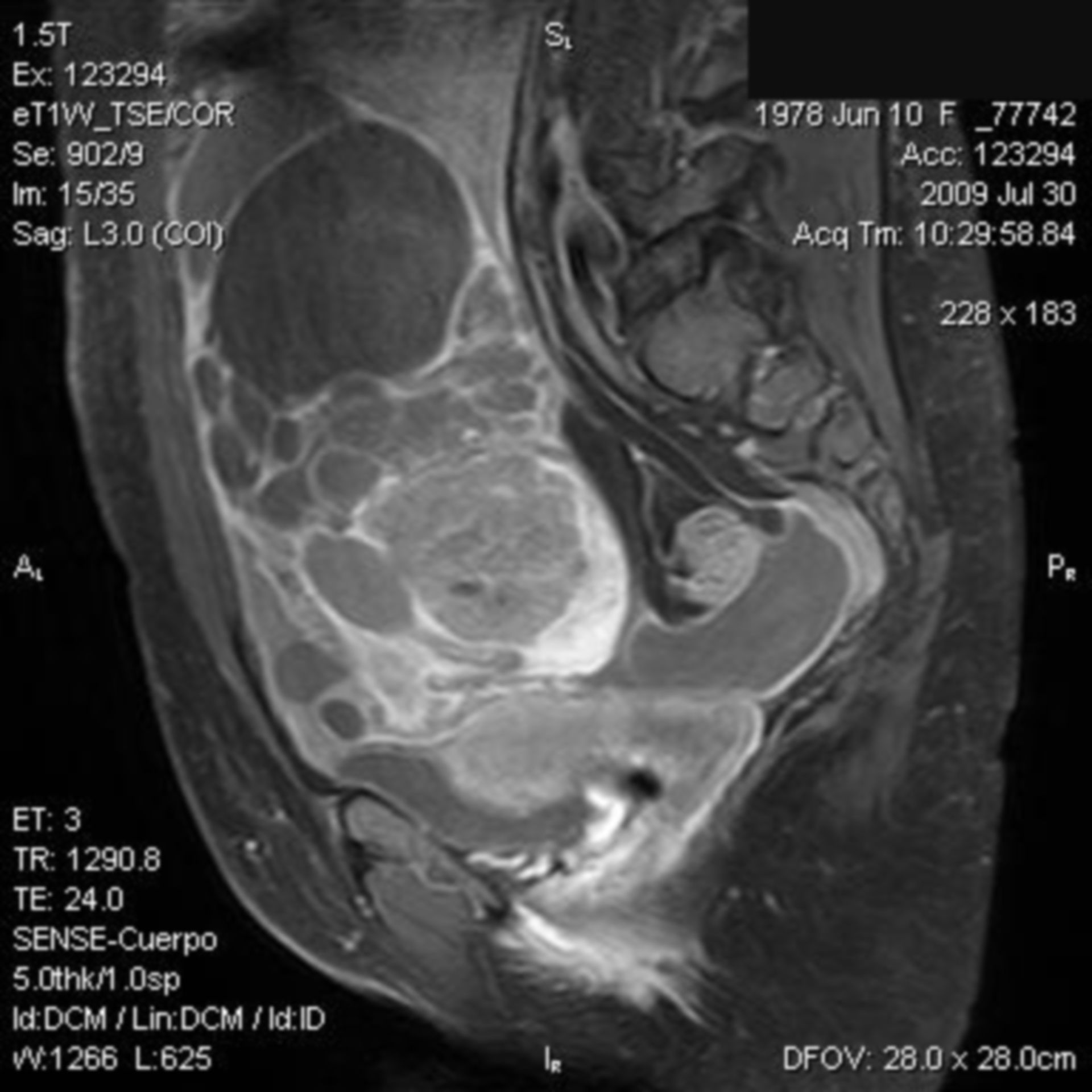 Carcinoma Borderline Mucinoso de Ovario con Recurrencia metastásica hepática ¿tumor ovárico o digestivo?