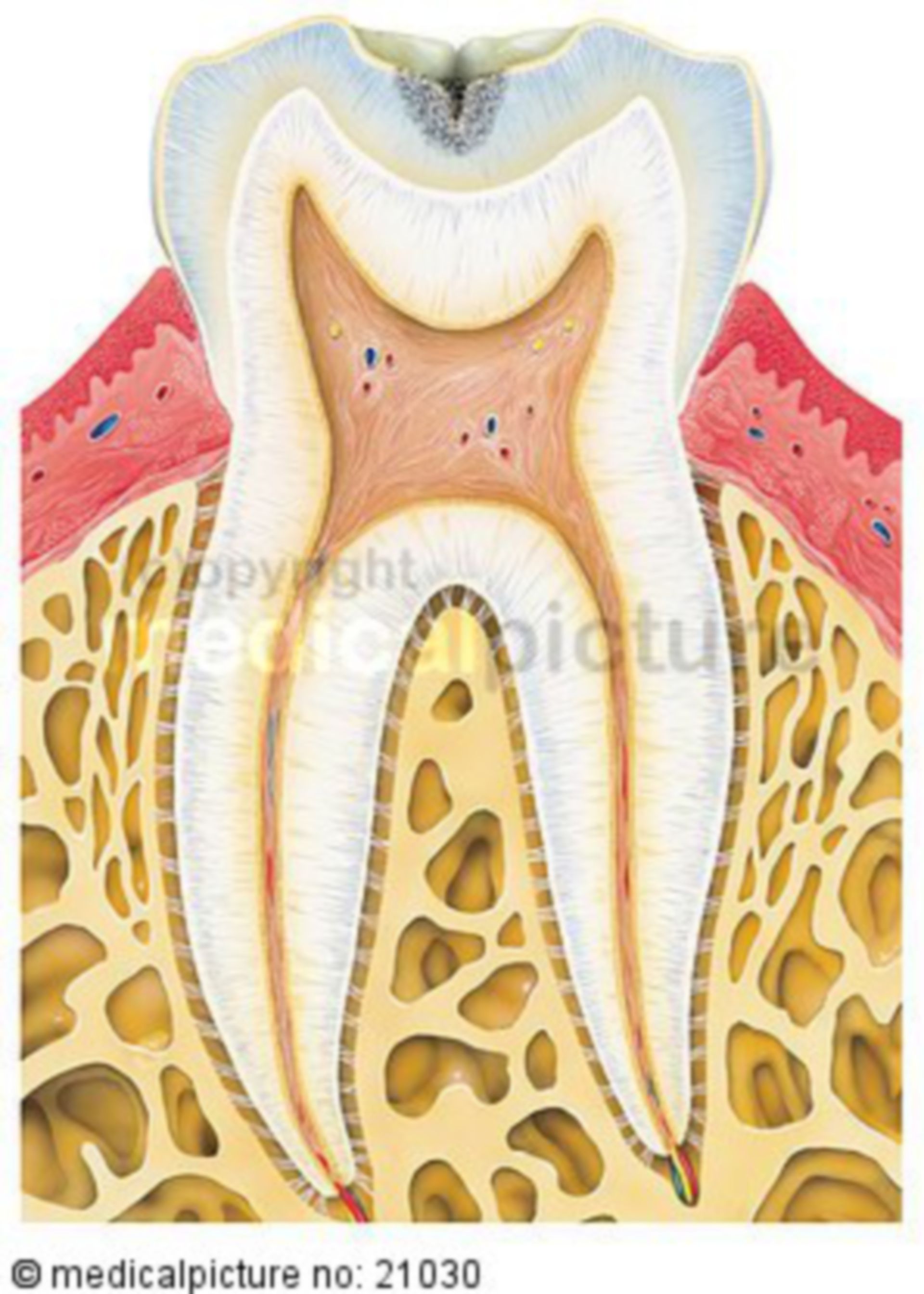  Karies befallener Zahn 
