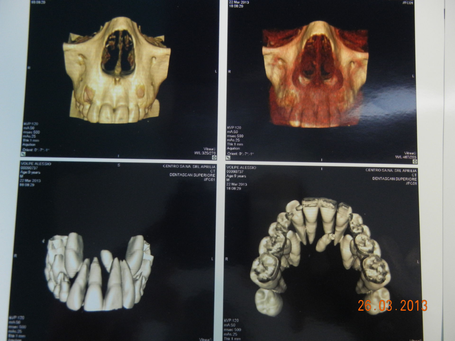 CT 3D der überzäligen Zähne