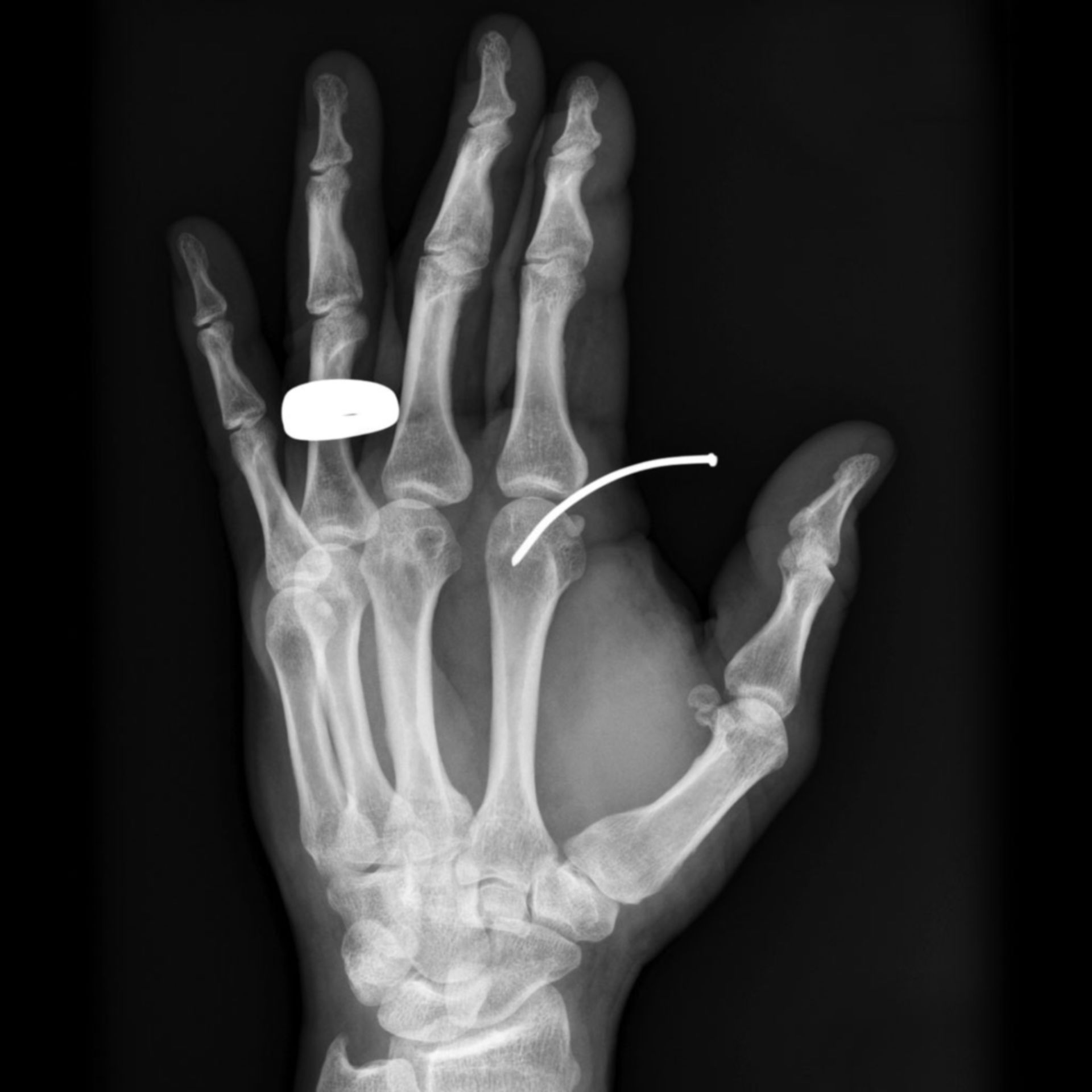 Nagel in der Hand (Röntgen)