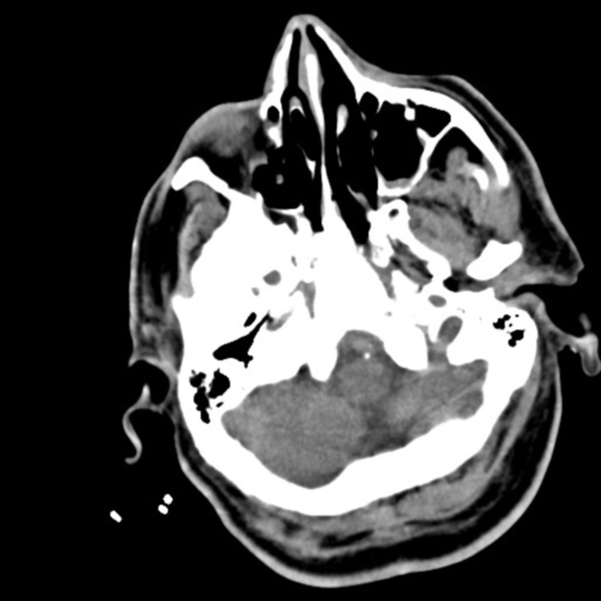 Gehirnblutung+Pneumonie 8