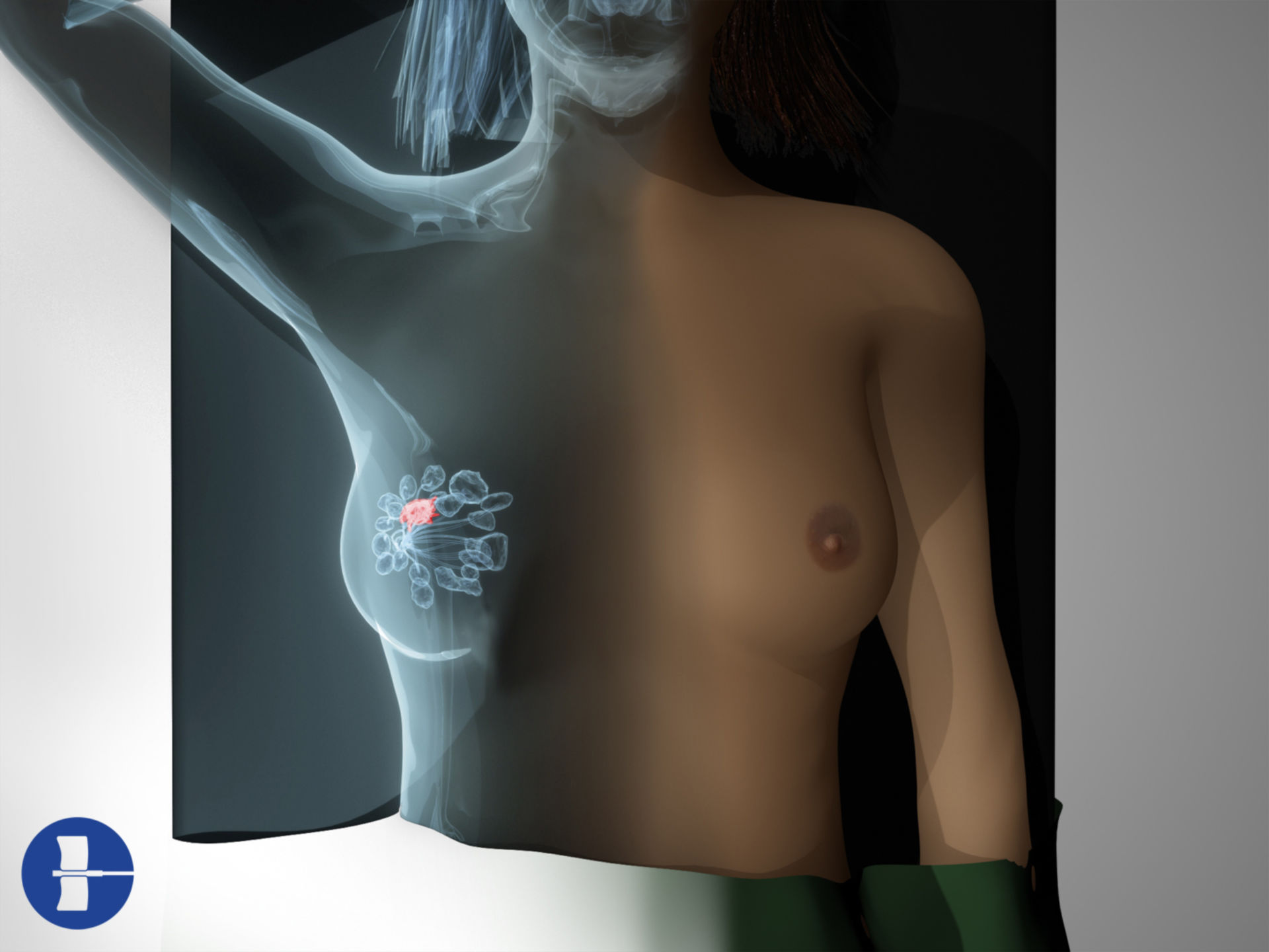 Breast cancer: position for radiation therapy/ X-Ray view