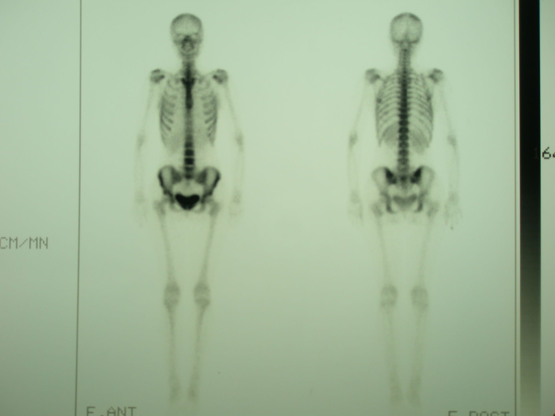 Spondylitis, Skelettszintigraphie