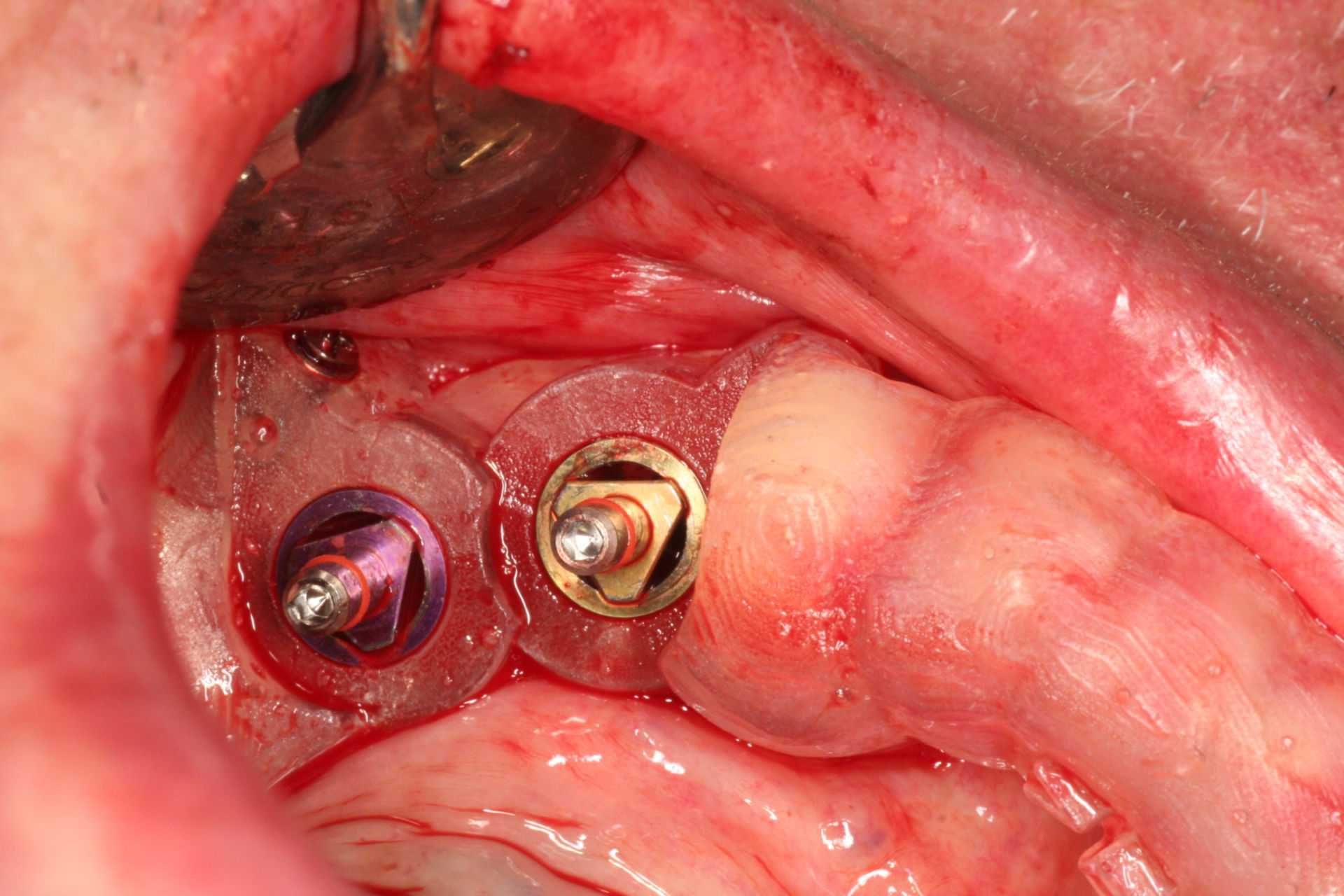 3d Guided Implant Placement