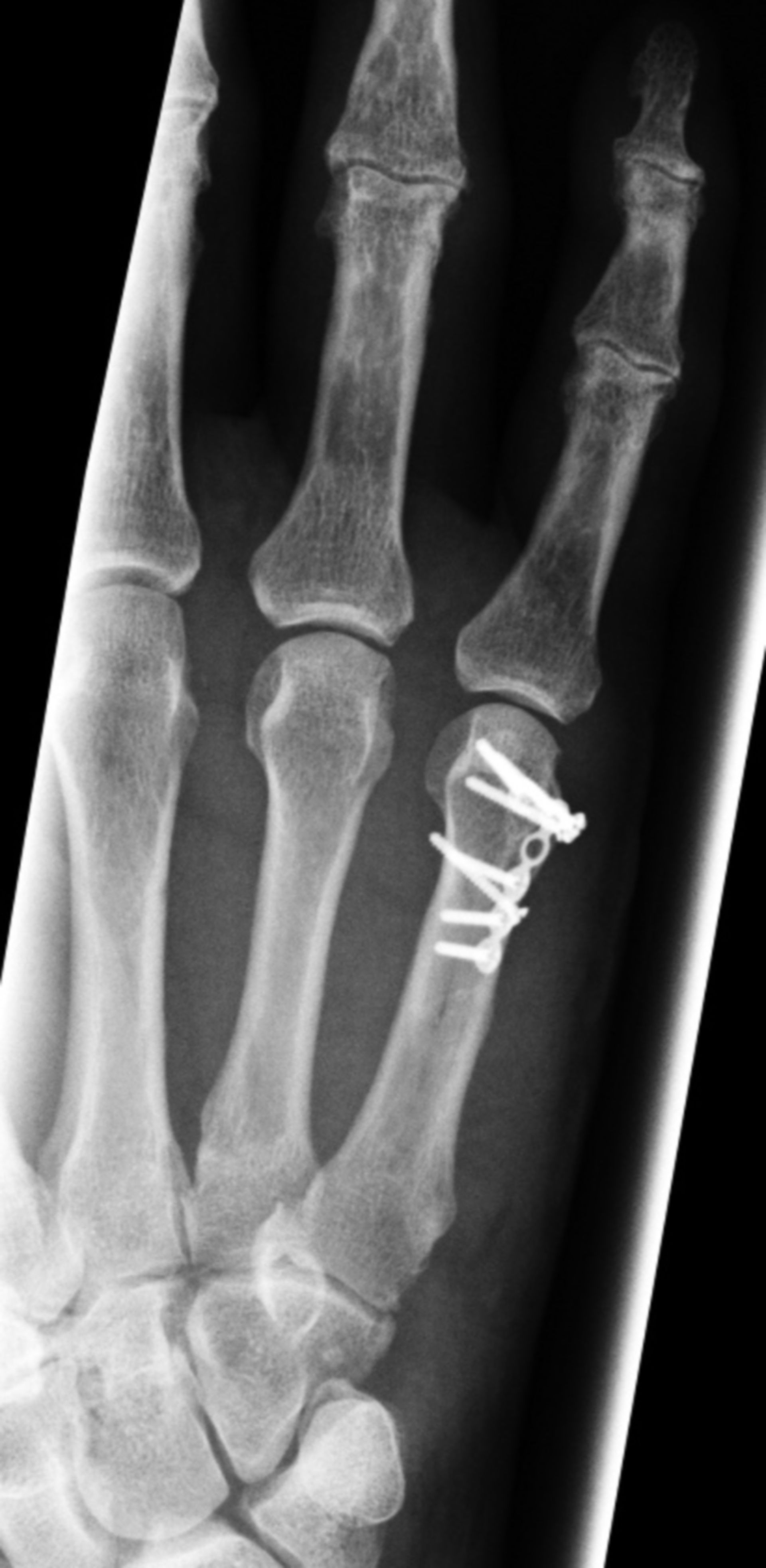 Metacarpal fracture osteosynthesis