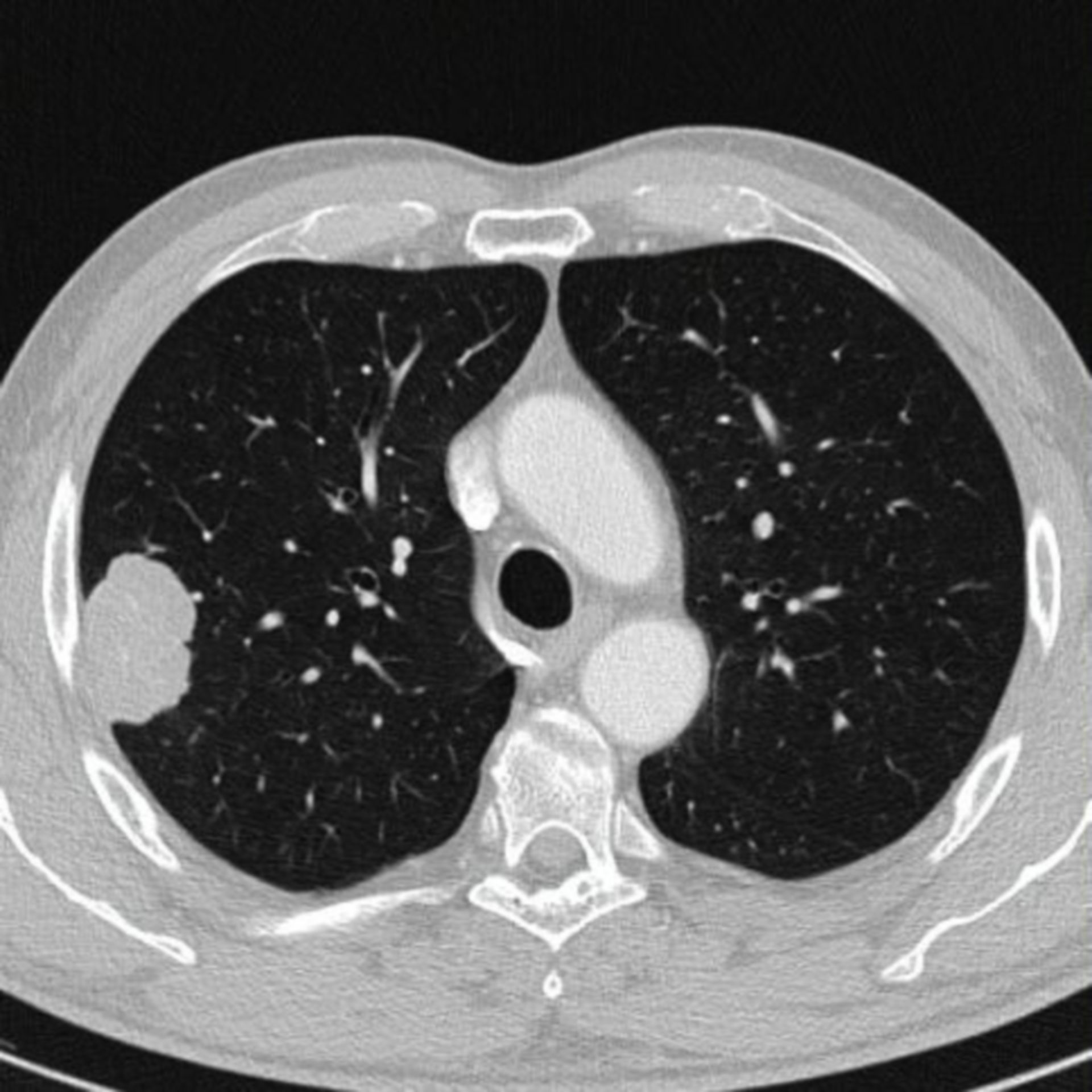 Raumforderung der rechten Lunge im CT