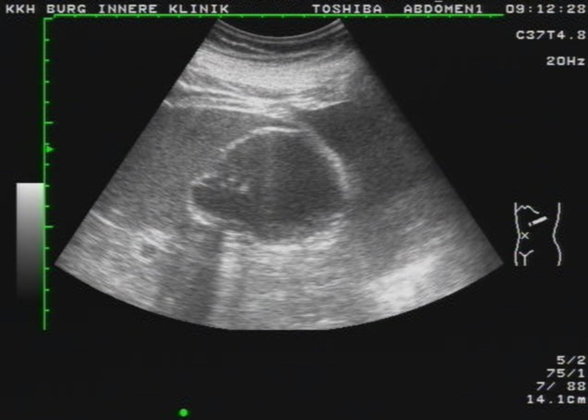 Splenic cyst