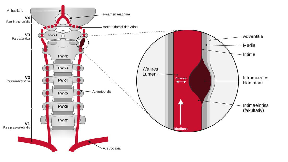 Vertebralisdissektion