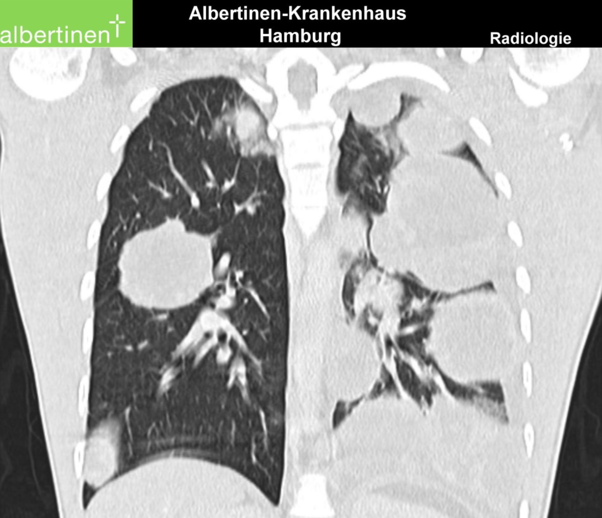 CT-Thorax Lungenmetastasen
