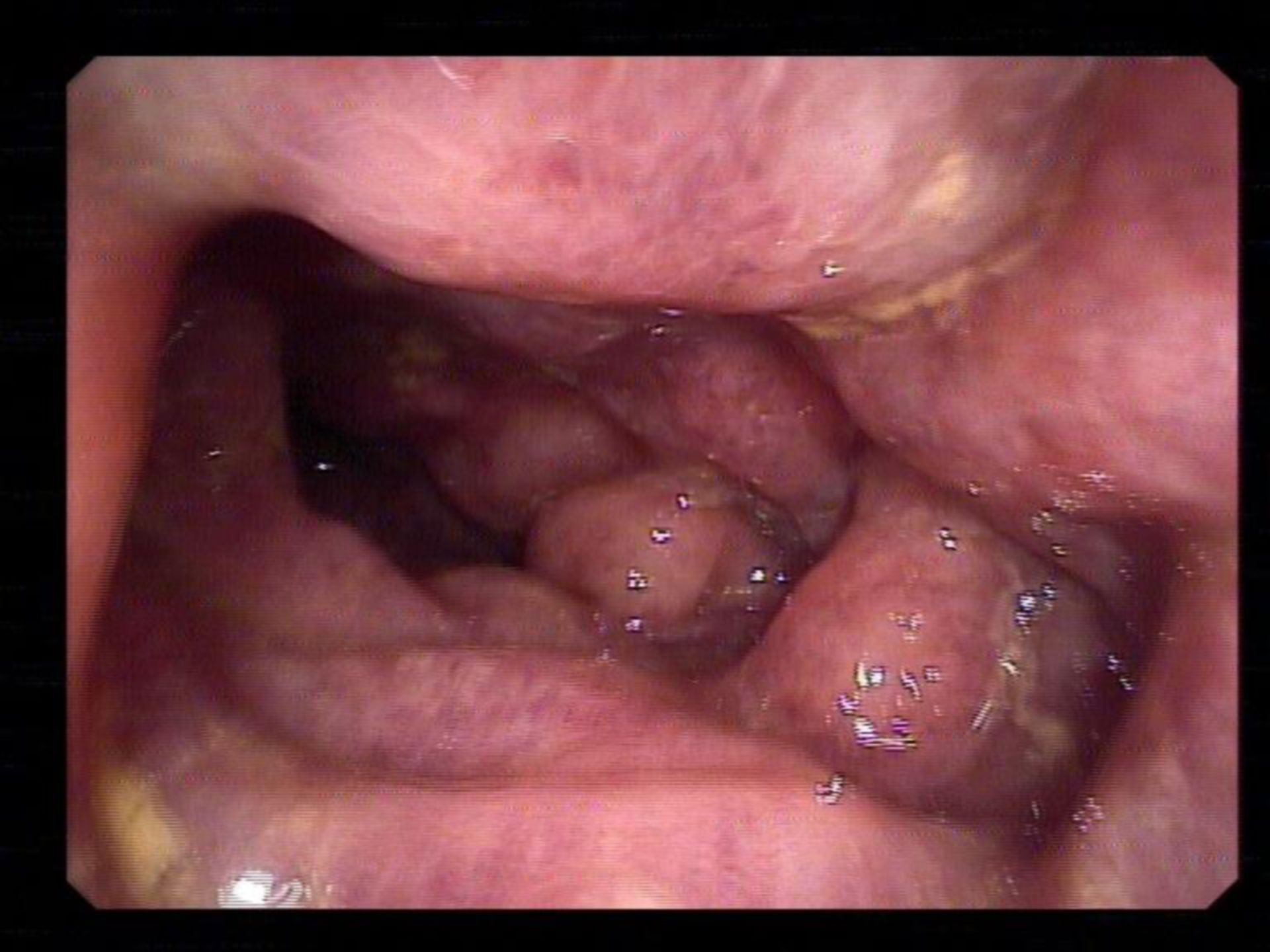 Colitis in EHEC infection