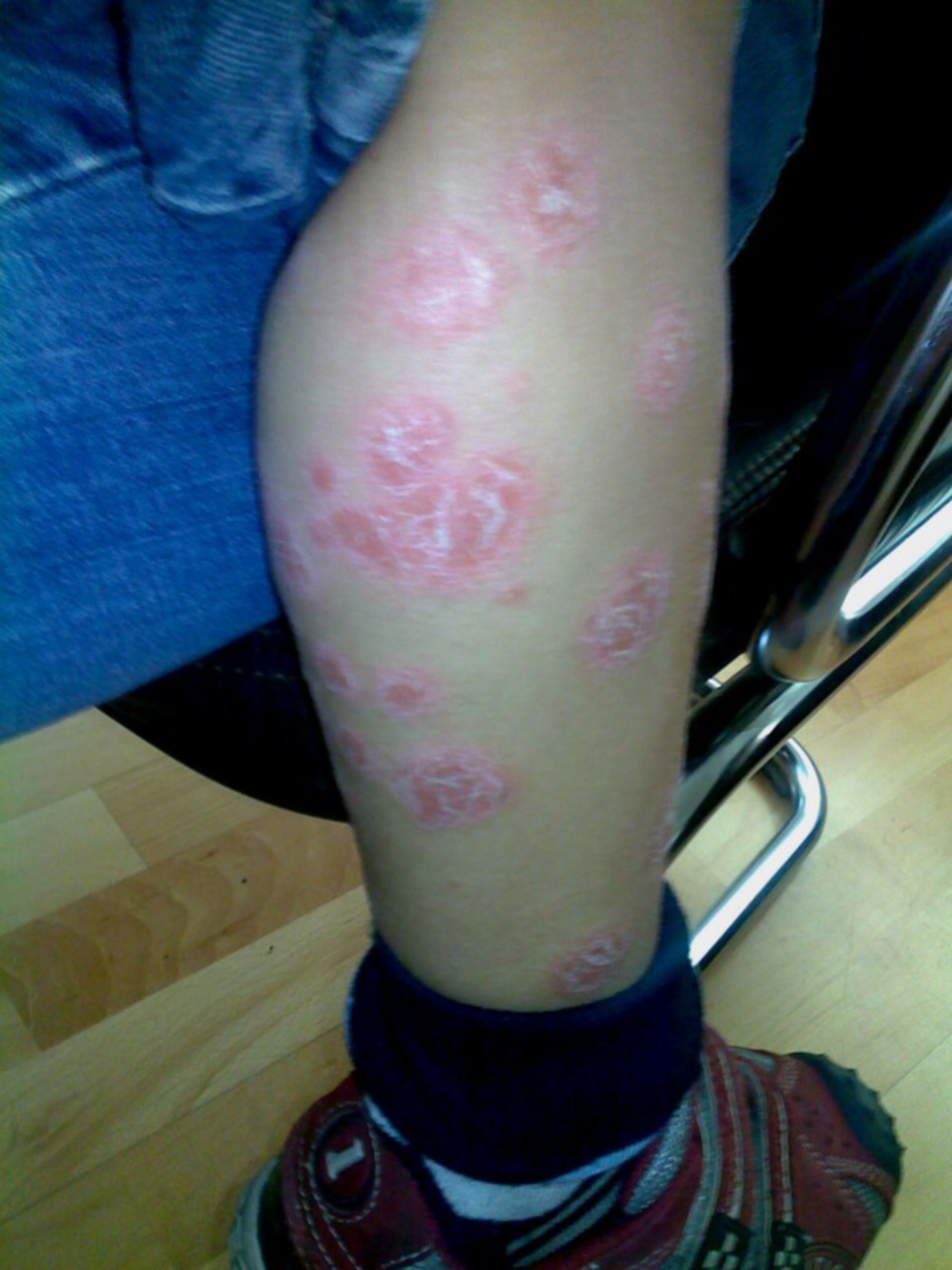 Psoriasis, re. Bein