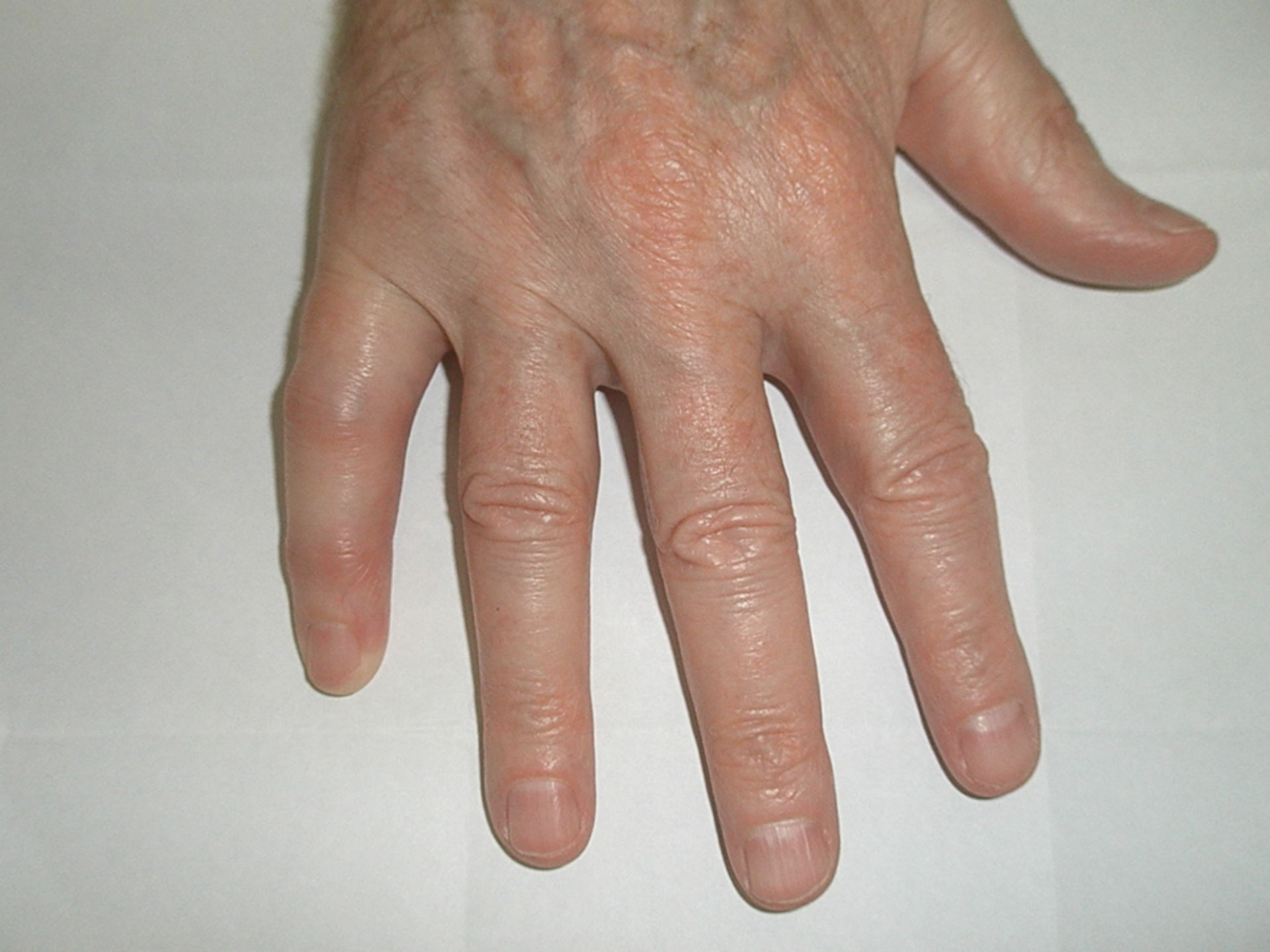 Dactylitis in psoriatic arthritis