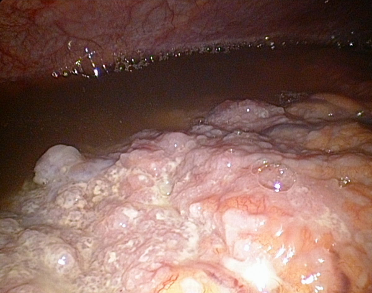 Peritonealcarcinose