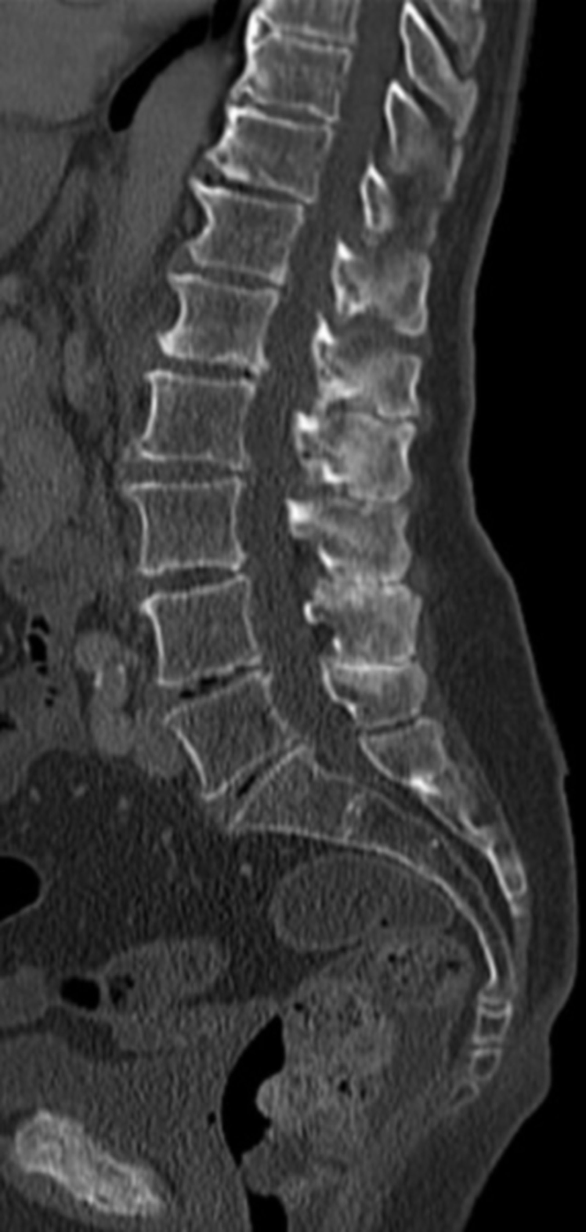 Baastrup CT sagittal