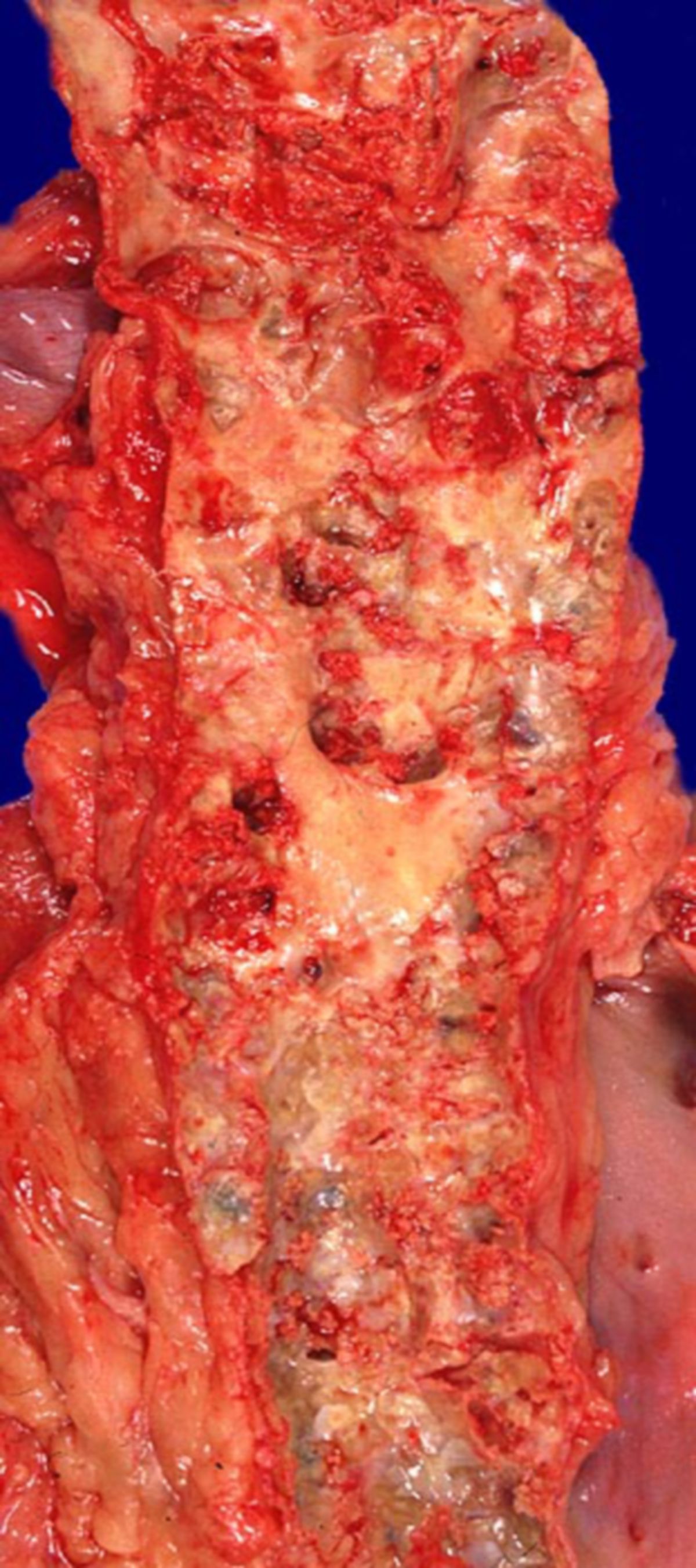 Aorta abdominalis (Schwere Atherosklerose)