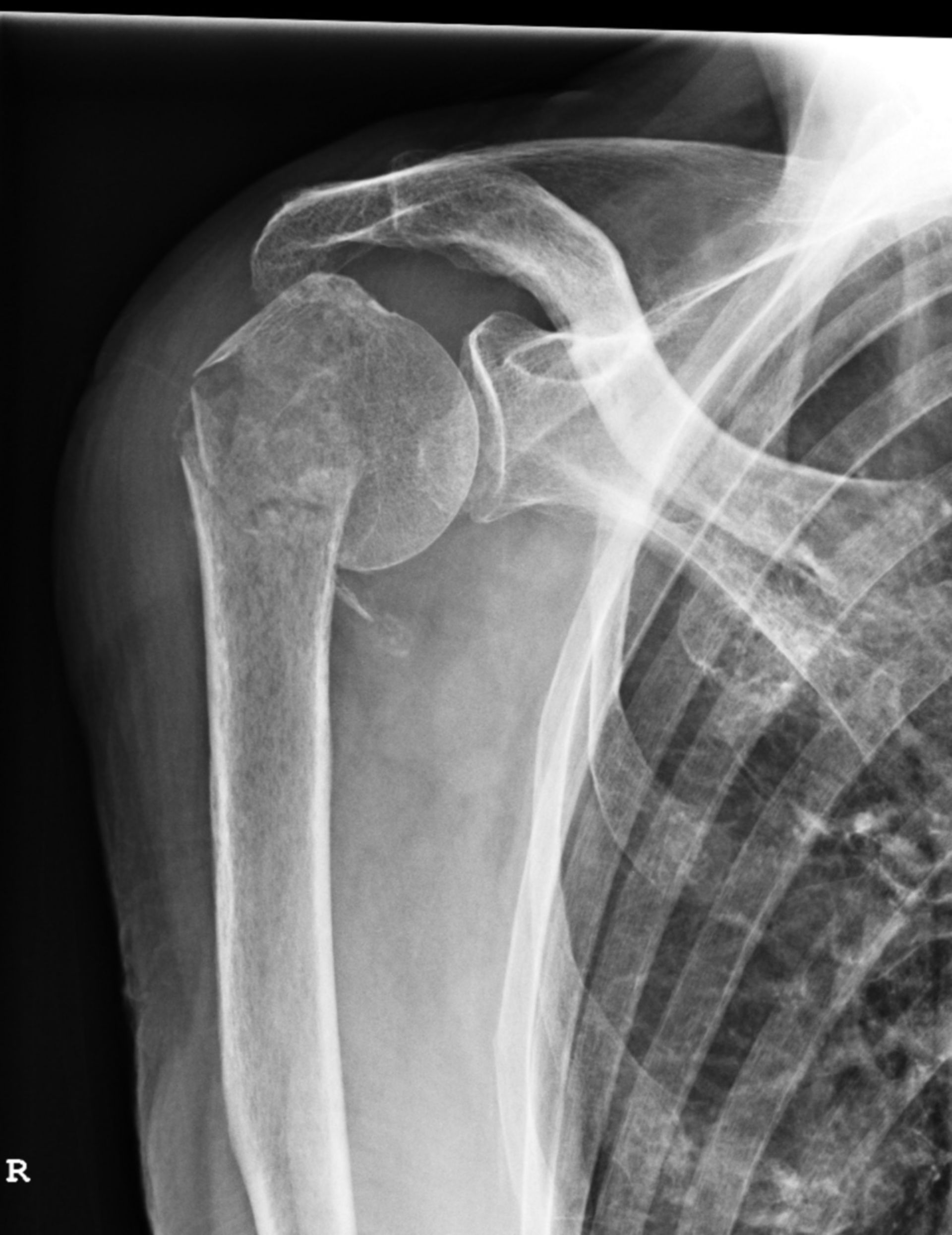 Proximal fracture of the humerus