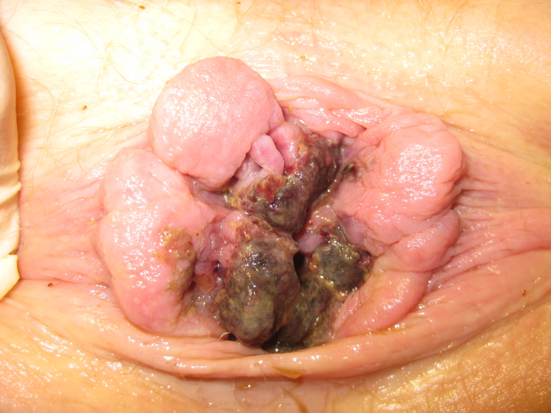 Grade IV hemorrhoids with thrombosis and necrosis
