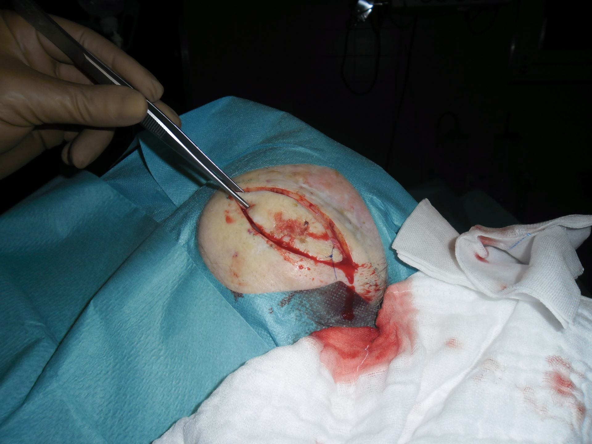 Carcinoma celular escamoso (sitio quirúrgico)